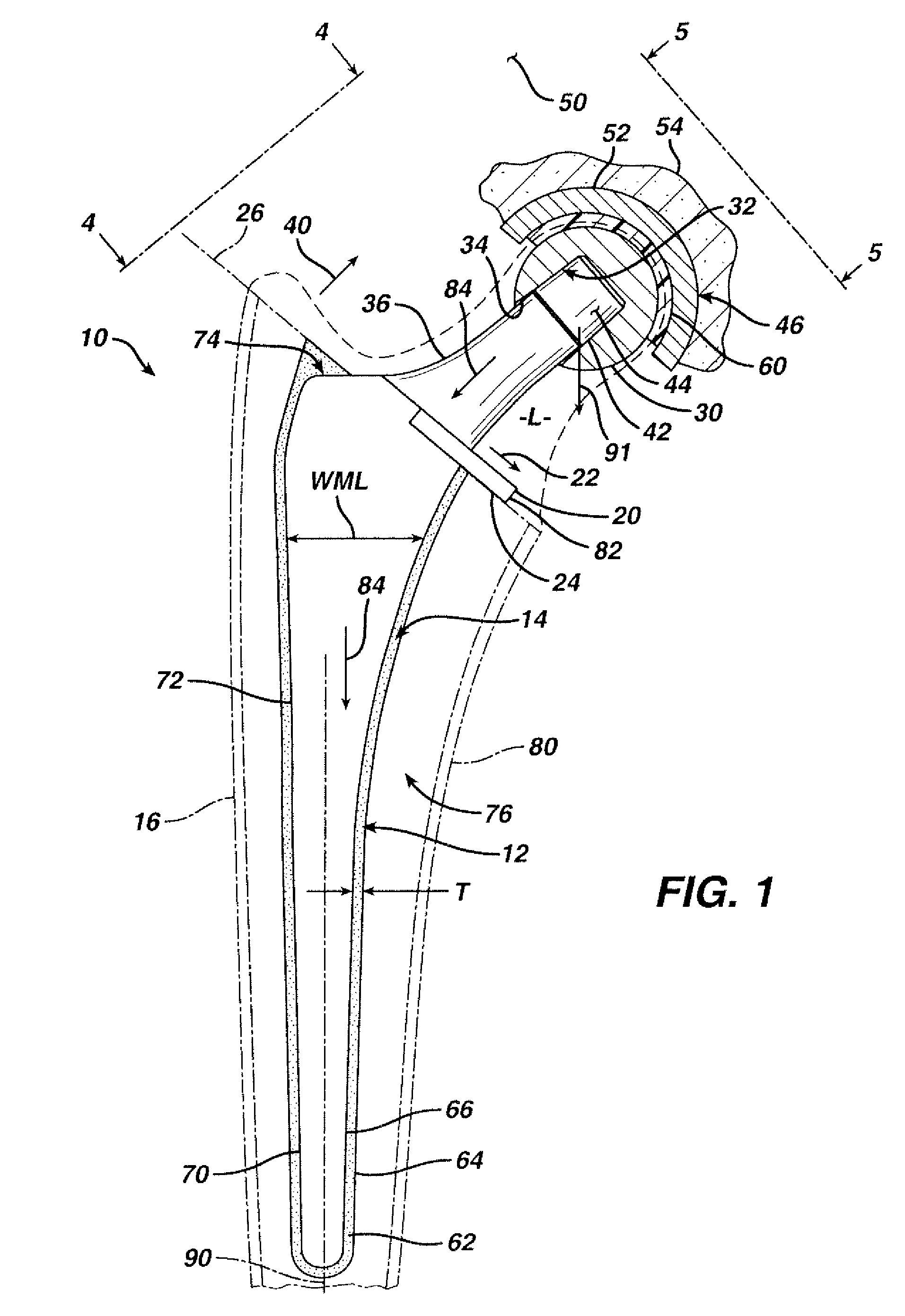 Prosthesis with resorbable collar