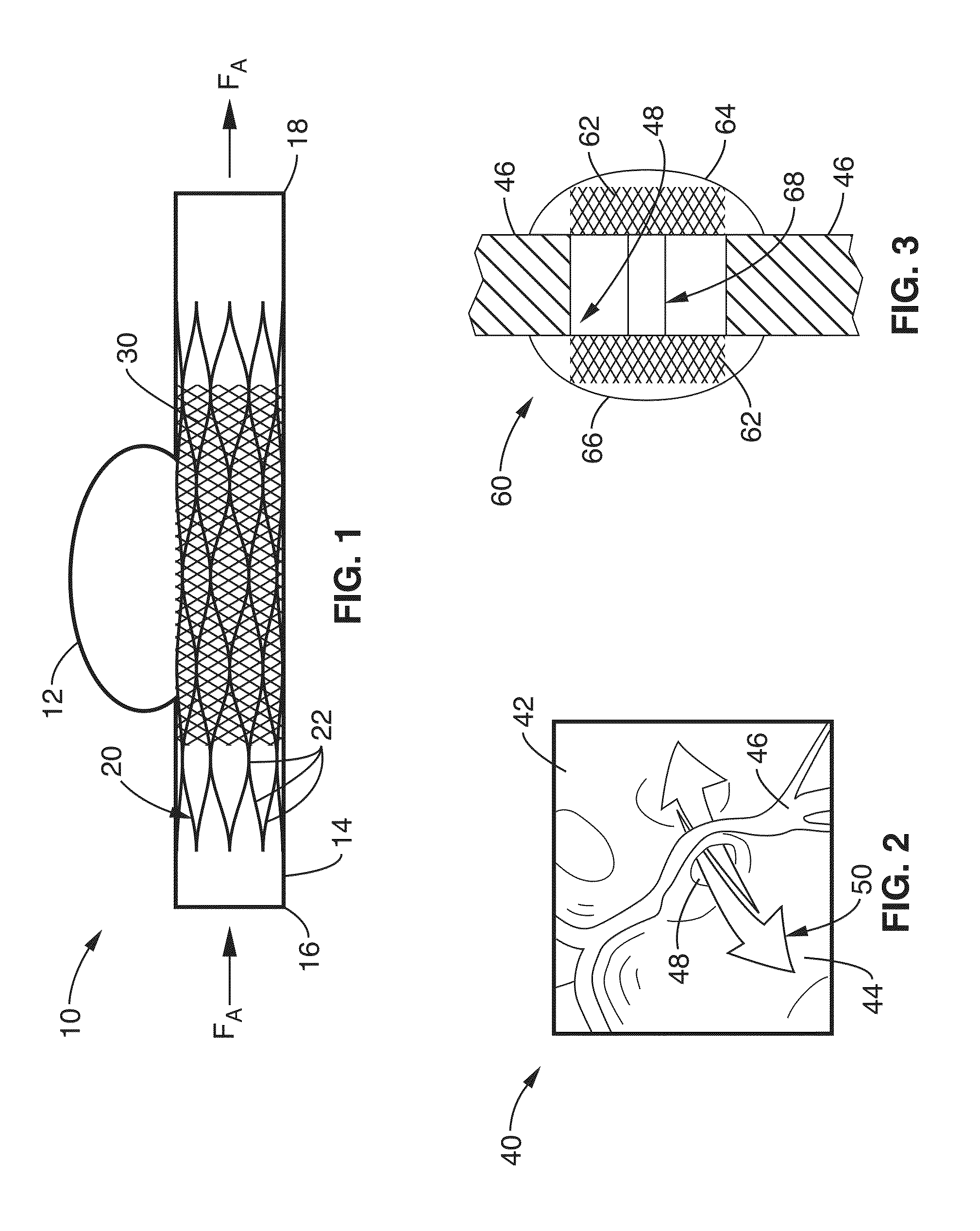 Ultra-low fractional area coverage flow diverter for treating aneurysms and vascular diseases