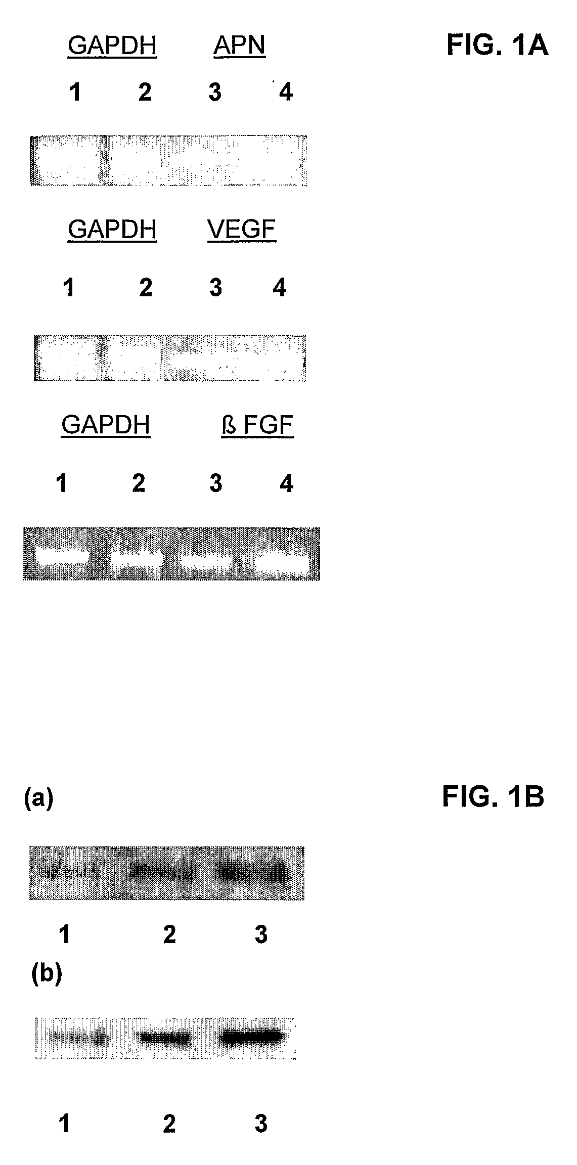 Inhibition of wet type age related macular degeneration (AMD) by adiponectin or acrp 30