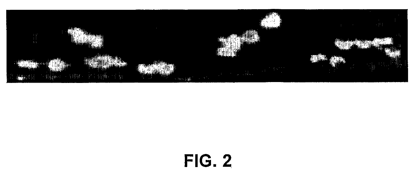 Inhibition of wet type age related macular degeneration (AMD) by adiponectin or acrp 30