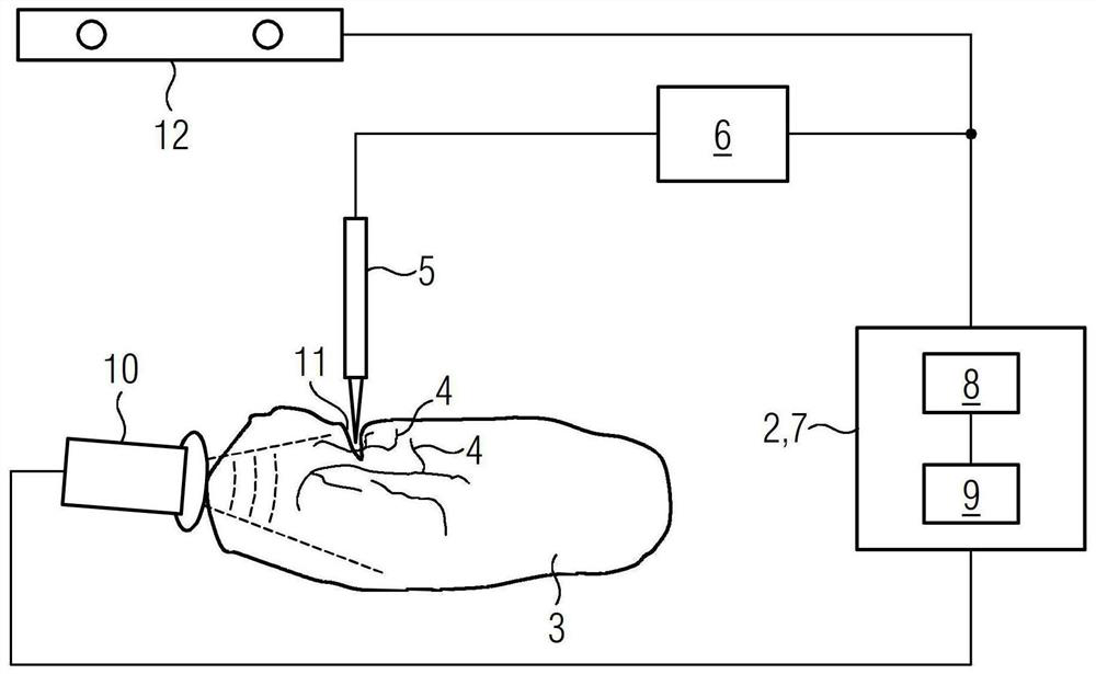 Method and system for supporting medical personnel during a resection, and computer program product