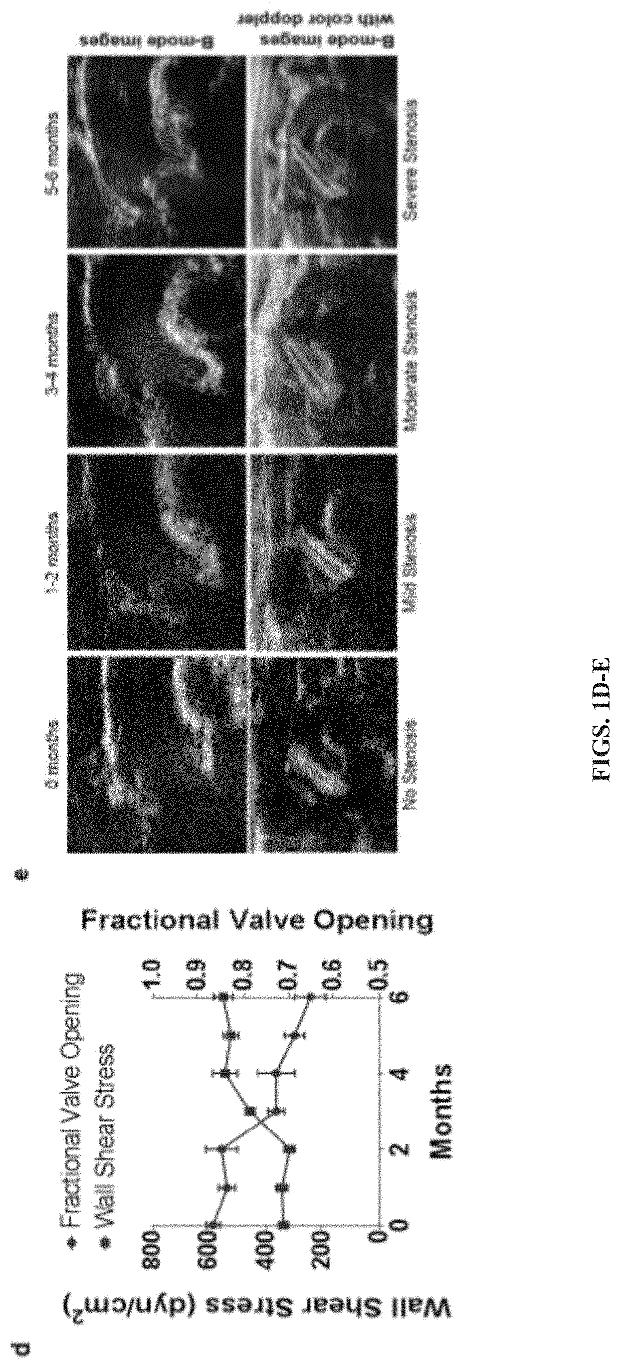 N-acetylcysteine attenuates aortic stenosis progression by inhibiting shear-mediated tgf-beta activation and signaling