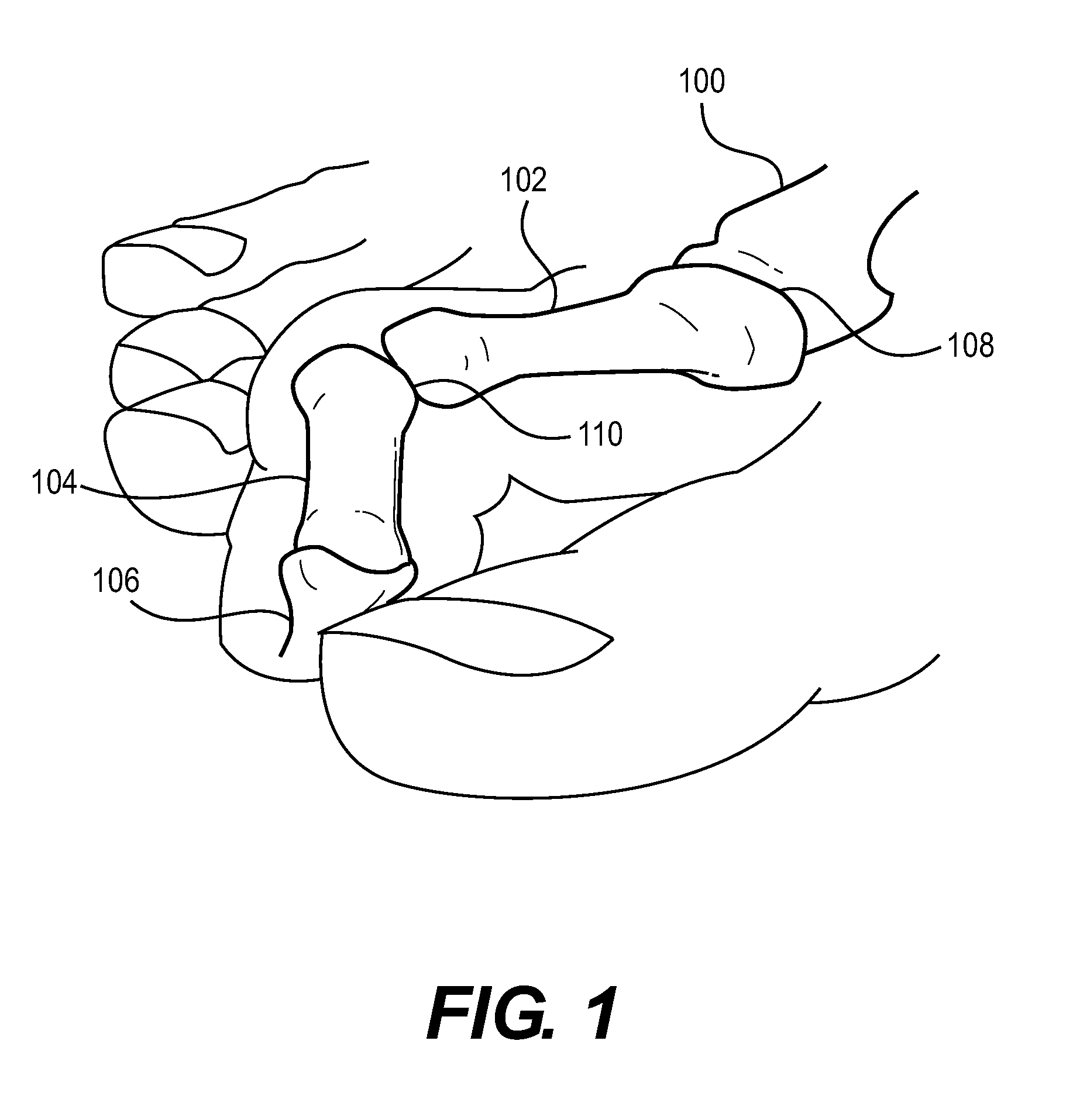 Interphalangeal Joint Implant Methods and Apparatus