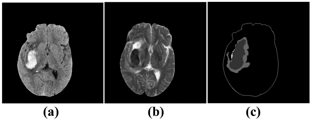 Encephaledema segmentation method and system based on support vector machine algorithm