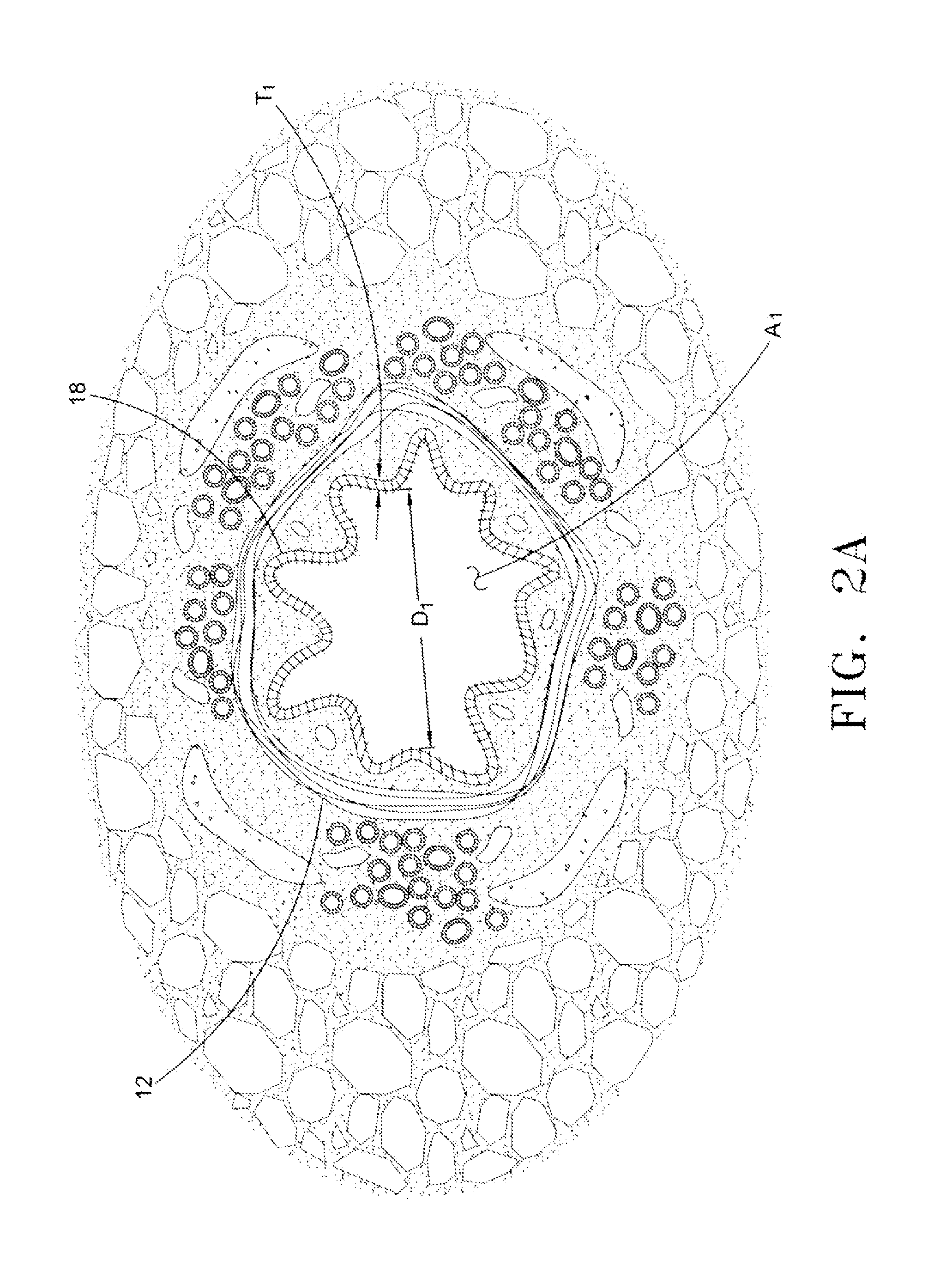 Irreversible Electroporation (IRE) for Congestive Obstructive Pulmonary Disease (COPD)