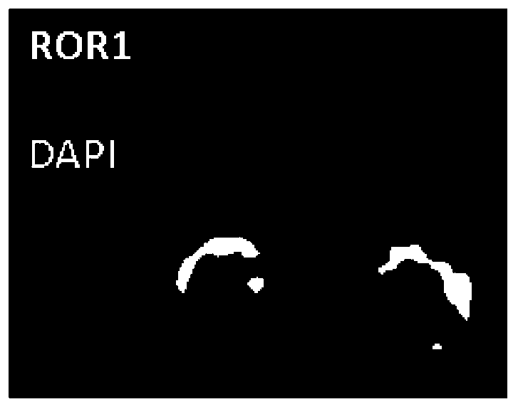 Reagent for detection of ROR1 protein of circulating tumor cells in peripheral blood and application thereof