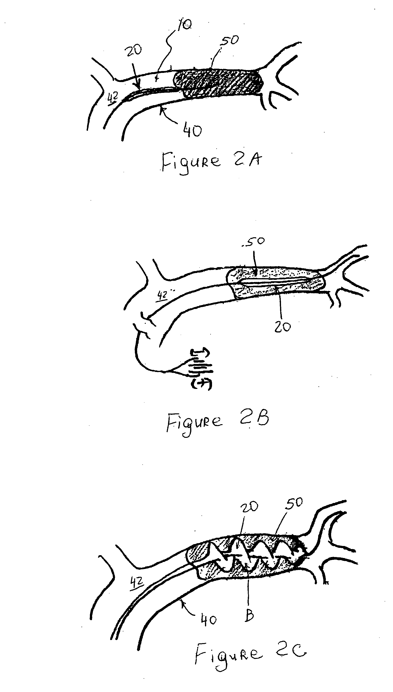 Devices and methods for removing a matter from a body cavity of a patient