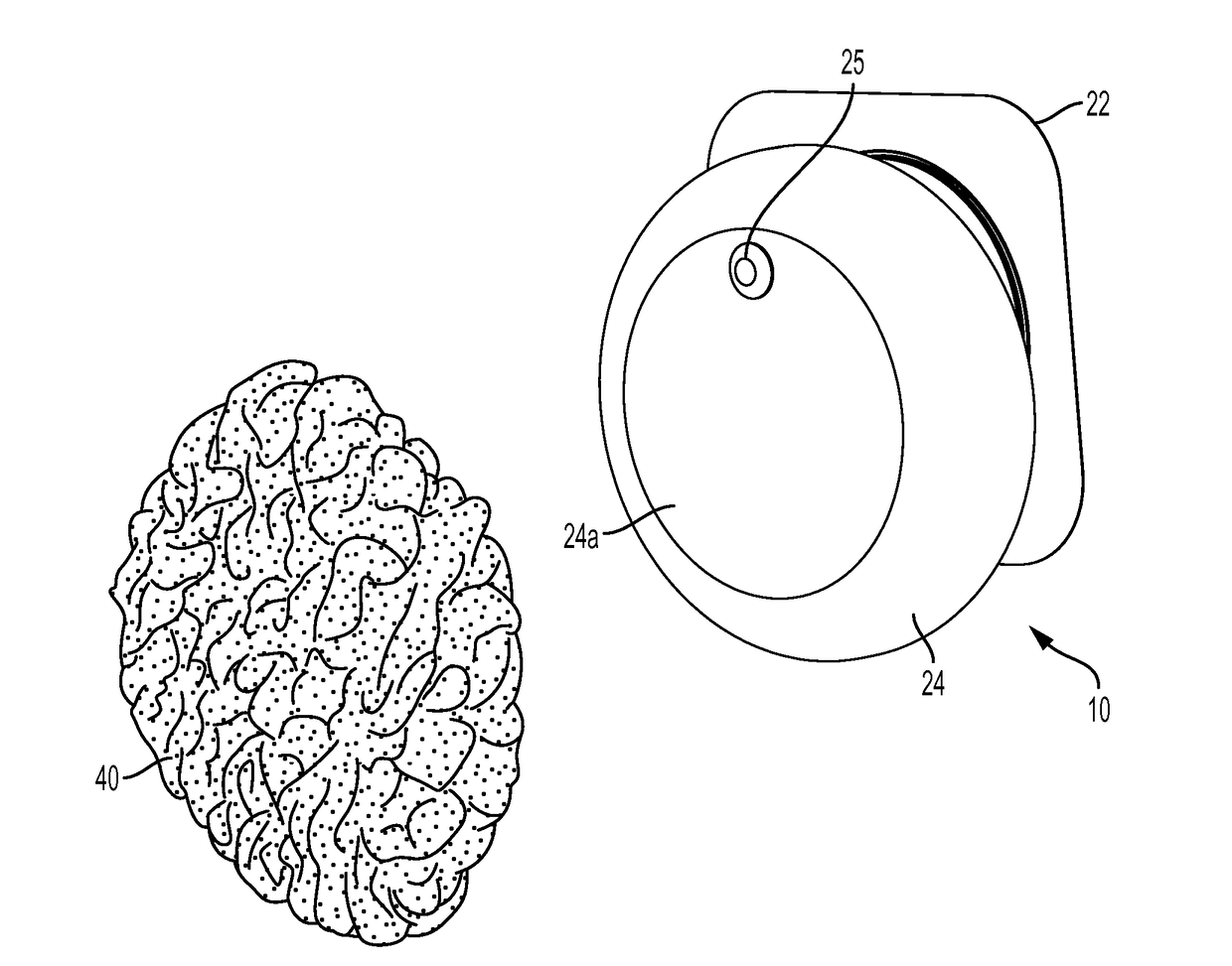 Ostomy appliance