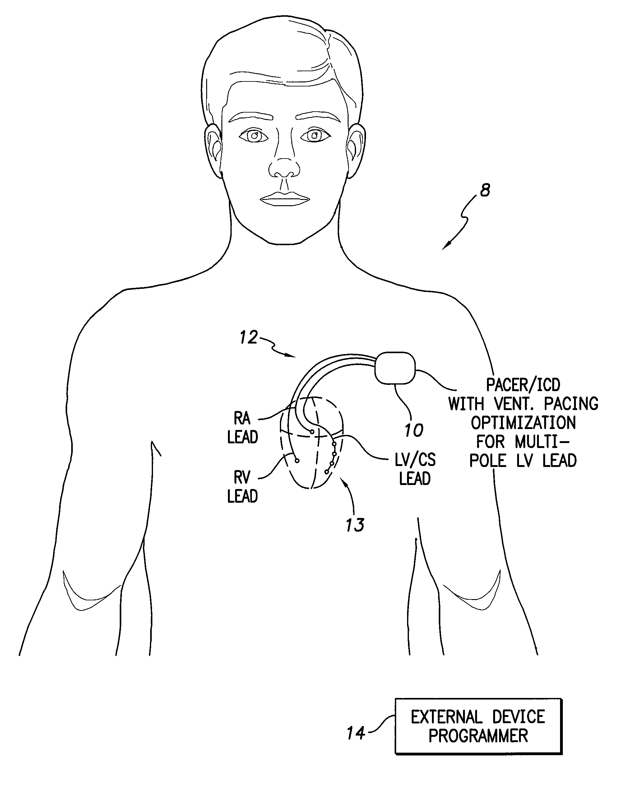 Systems and methods for optimizing ventricular pacing delays for use with multi-pole leads