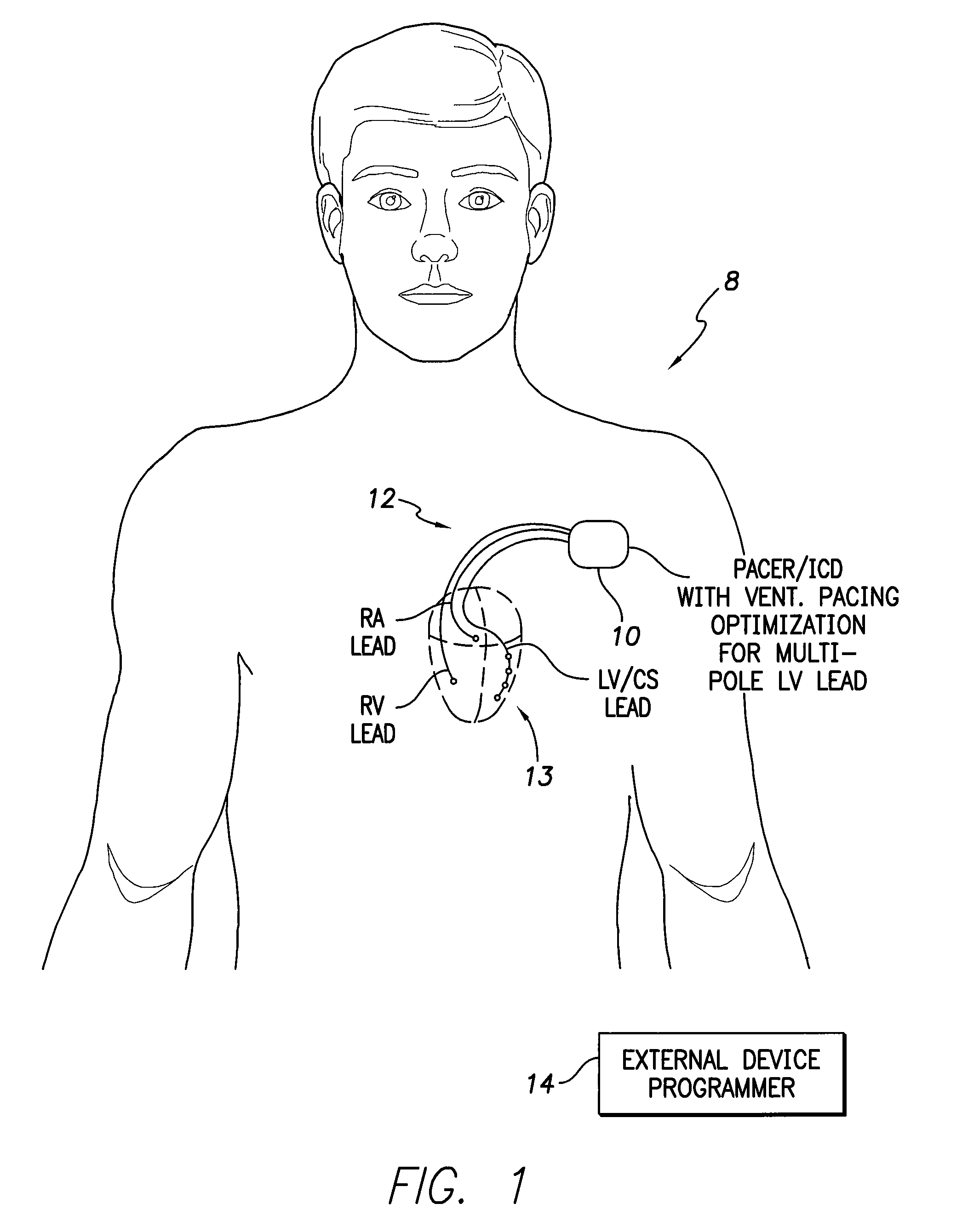 Systems and methods for optimizing ventricular pacing delays for use with multi-pole leads