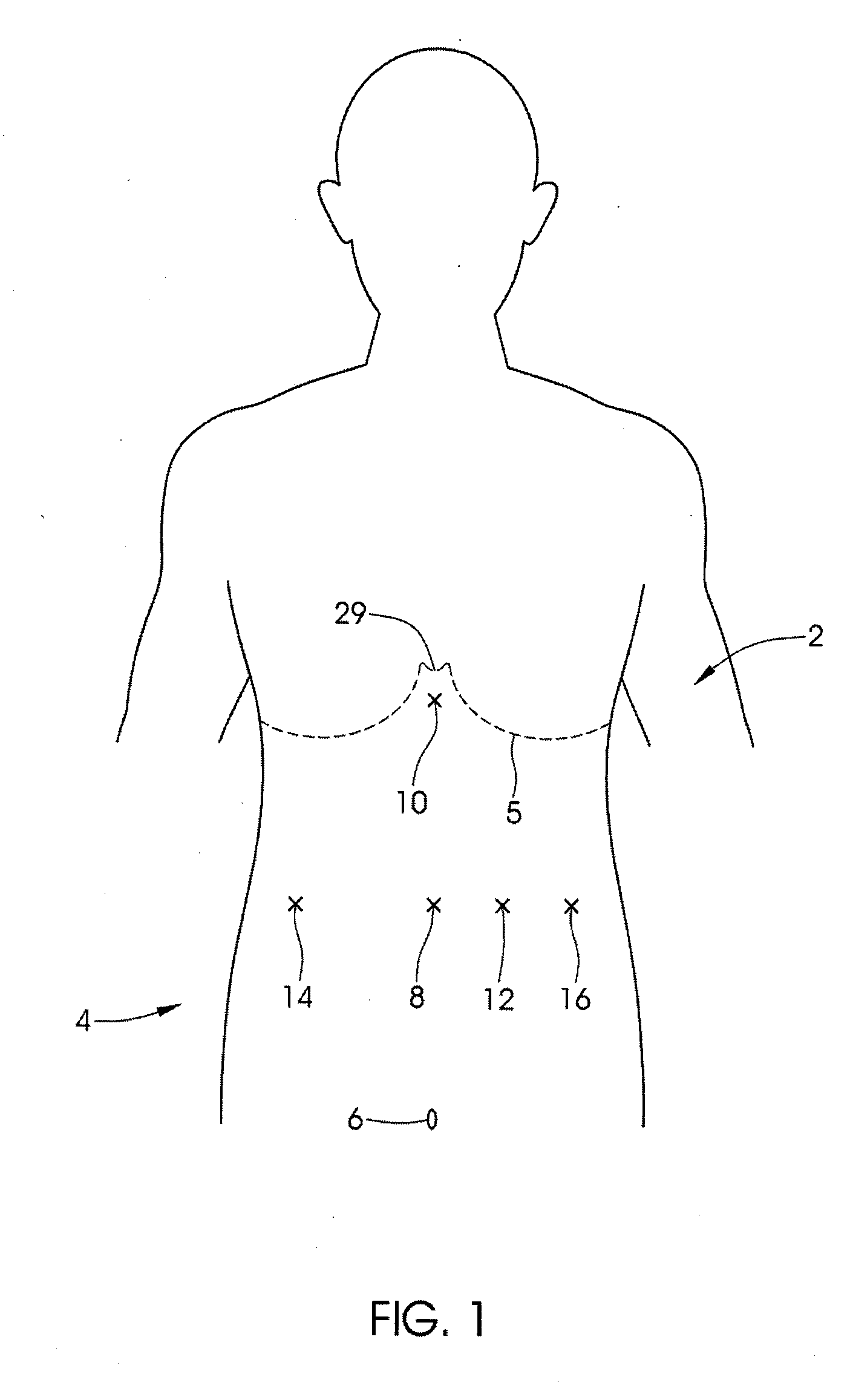 Method and apparatus for adjusting a gastrointestinal restriction device