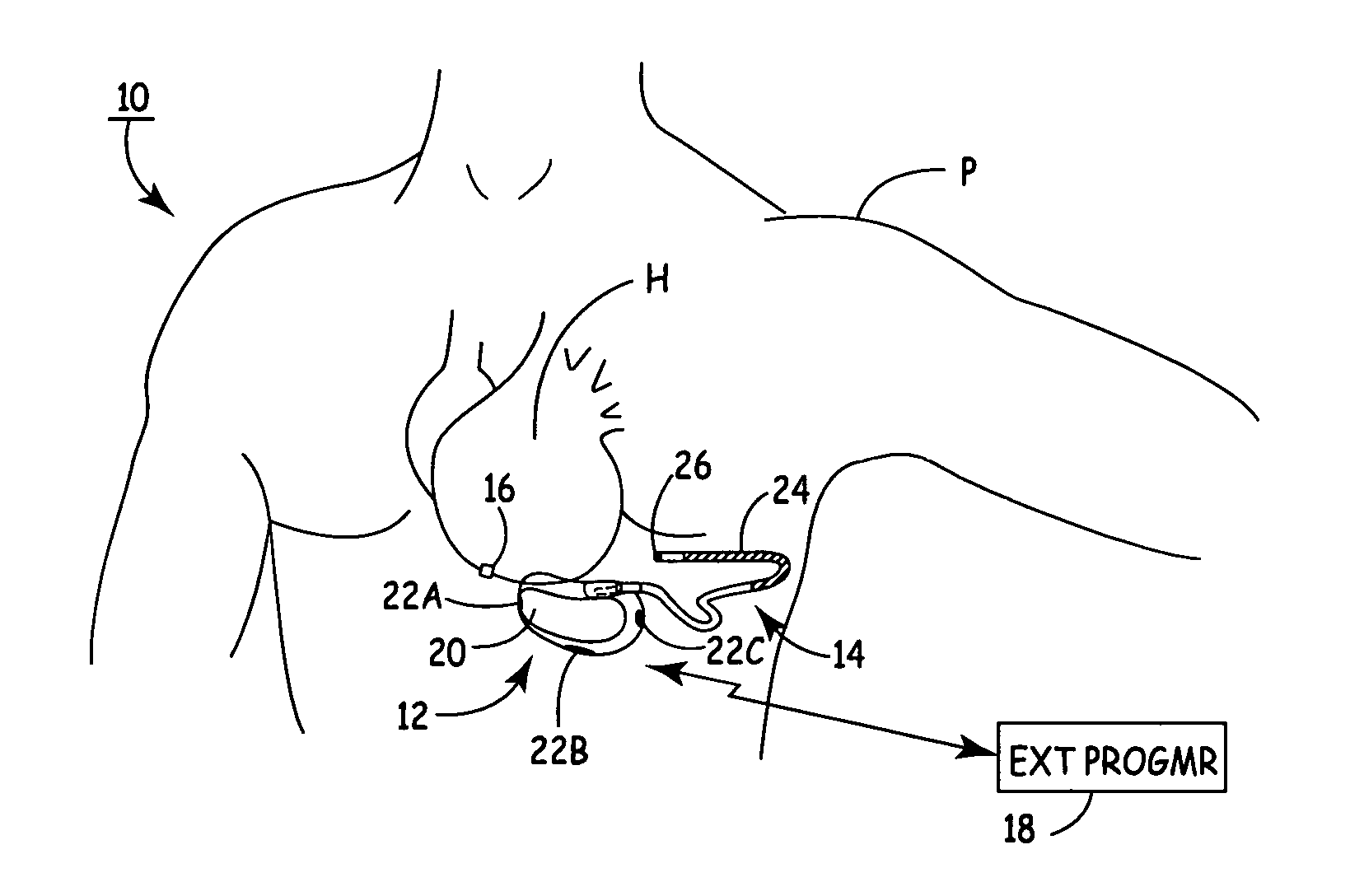 Subcutaneous ICD with separate cardiac rhythm sensor