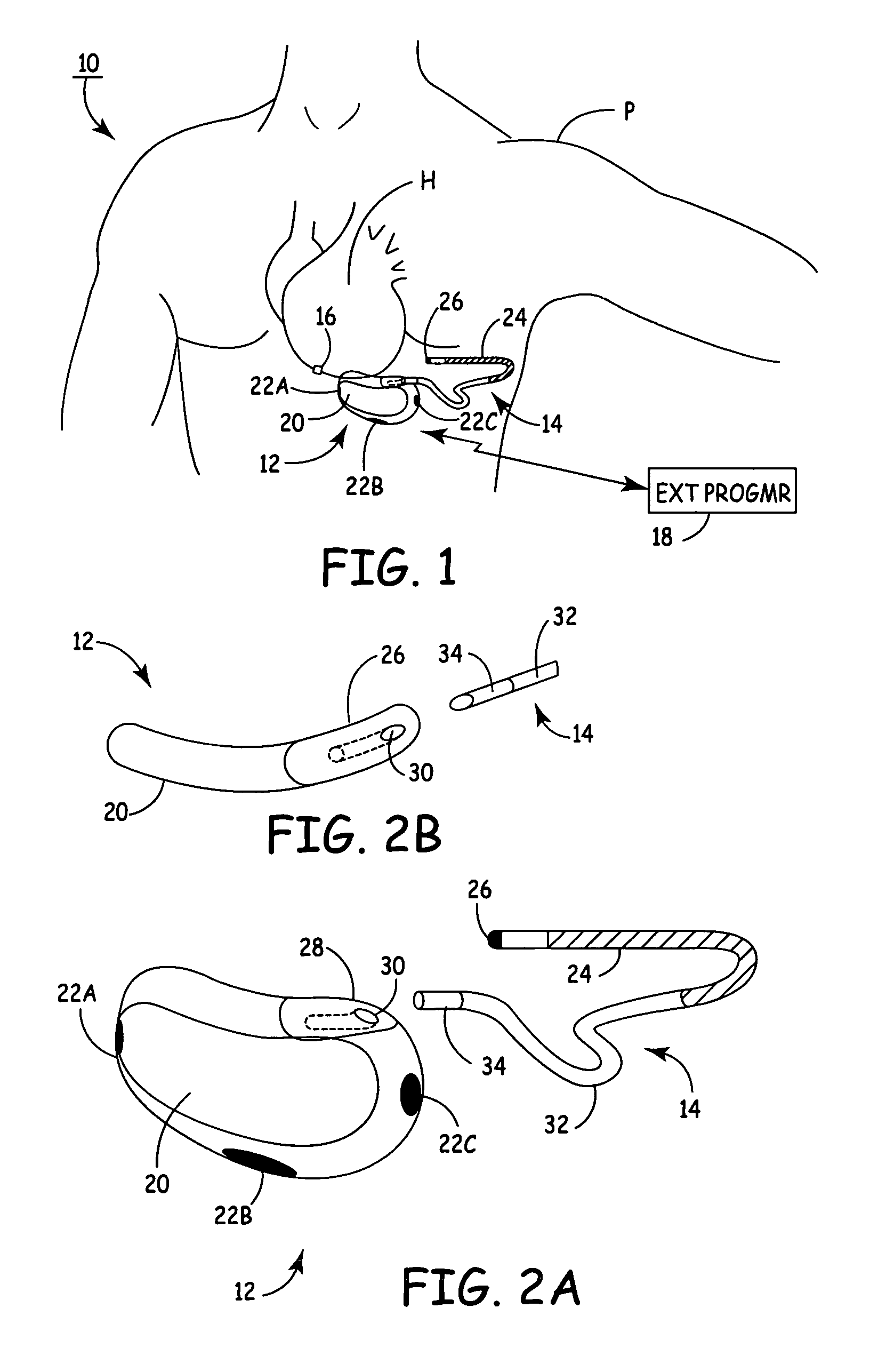 Subcutaneous ICD with separate cardiac rhythm sensor