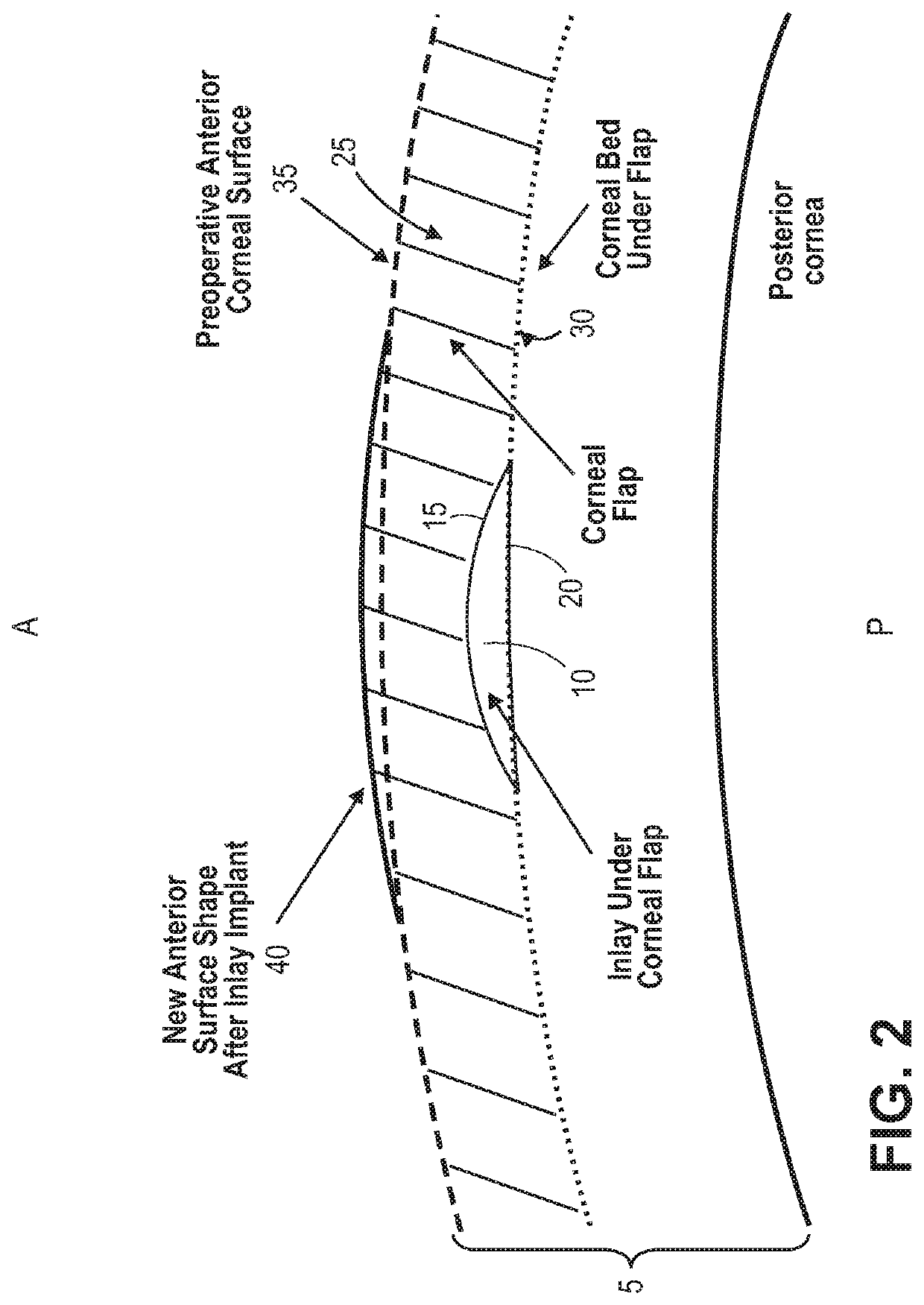 Methods of correcting vision