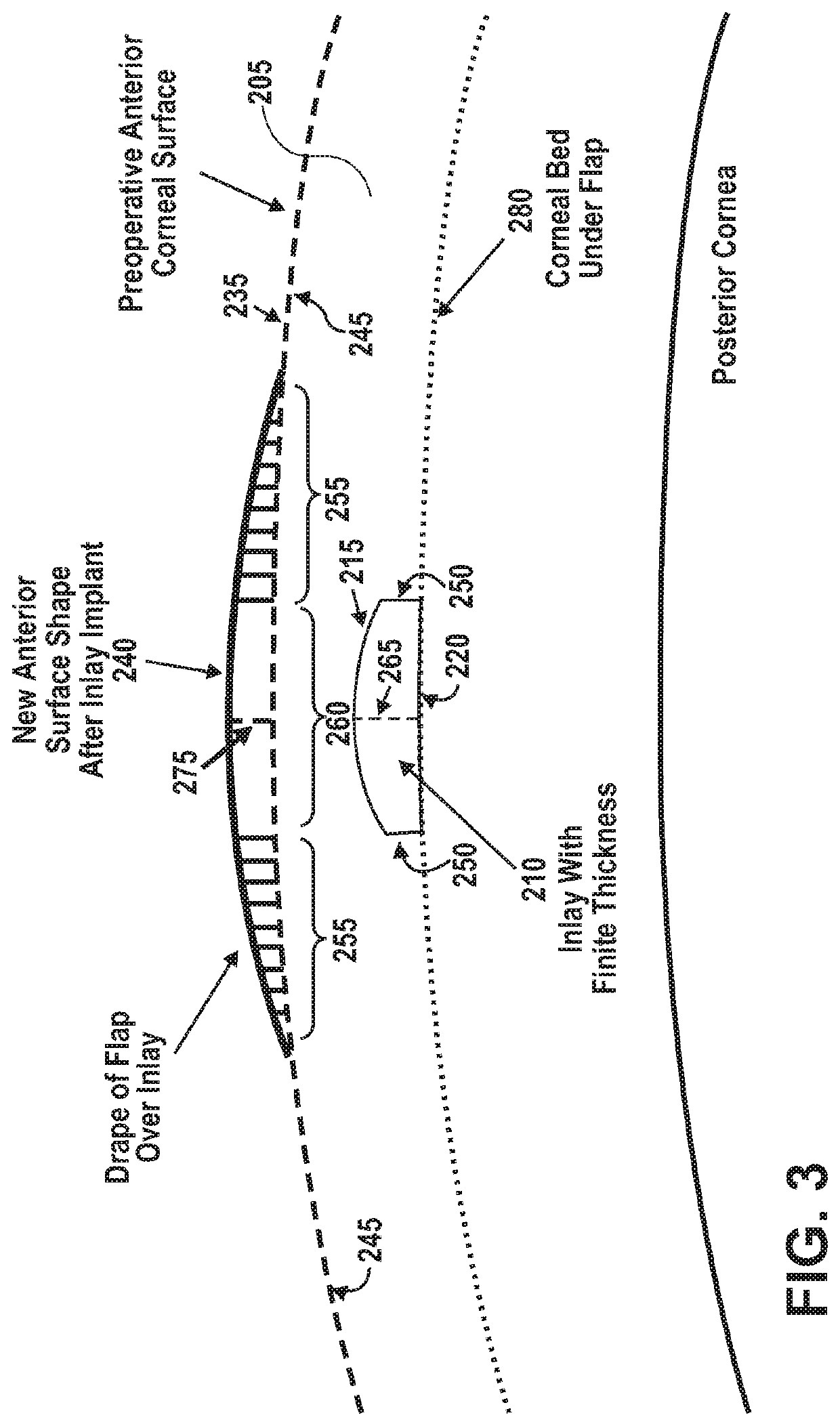 Methods of correcting vision