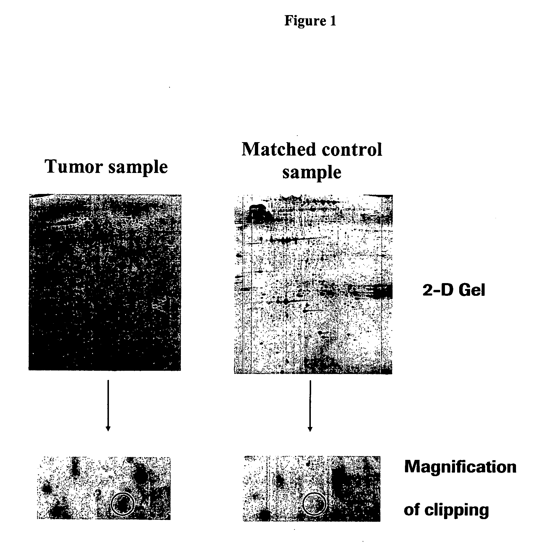 Cellular retinoic acid binding protein II as a marker for breast cancer