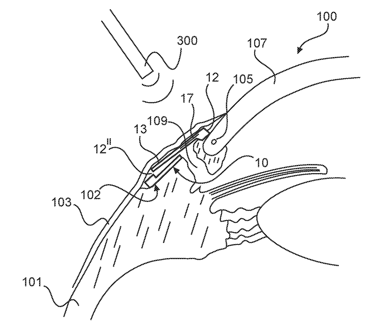 Glaucoma drainage implant