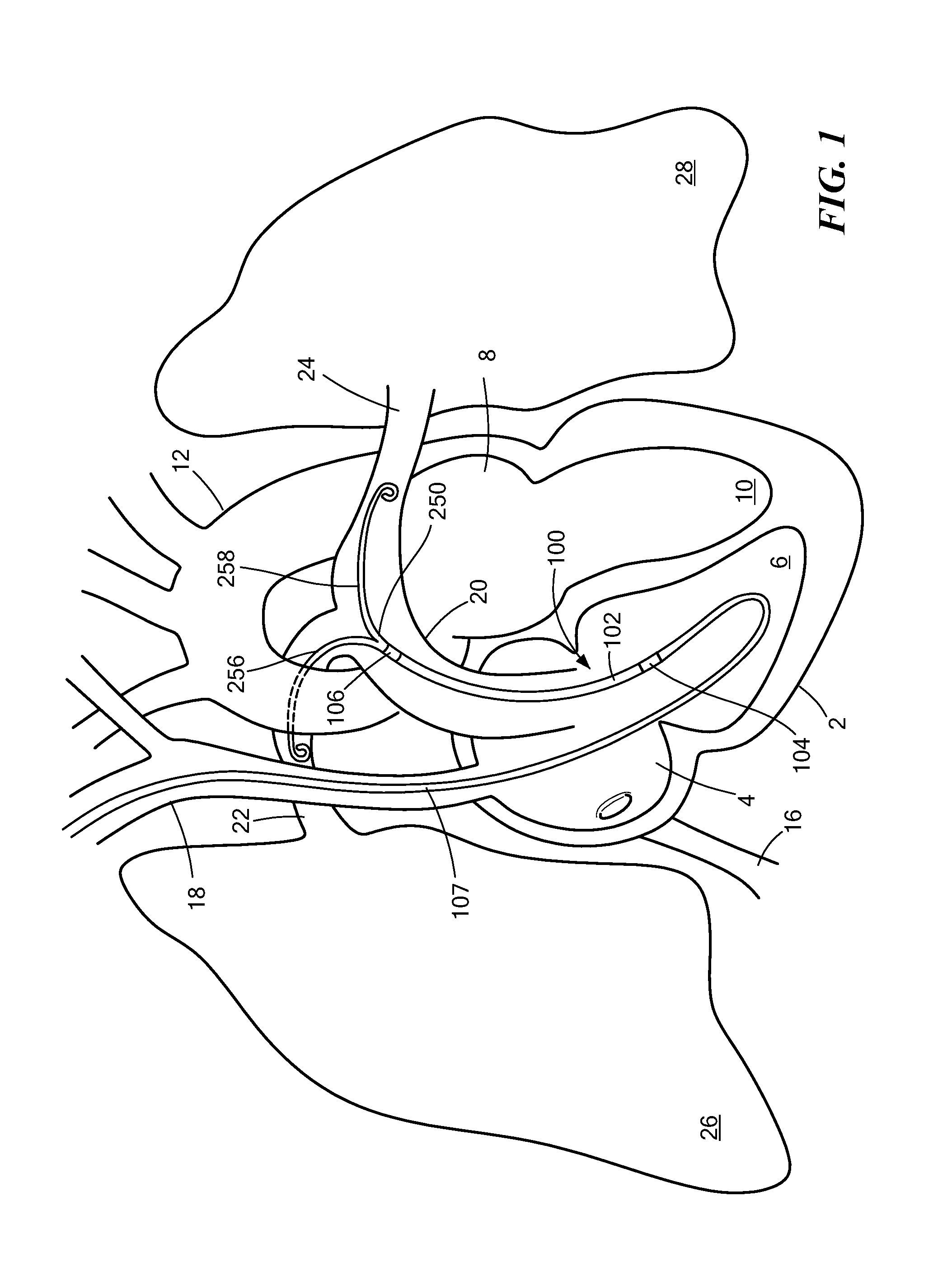 Cannula with bifurcated tip for a cardiac assist device