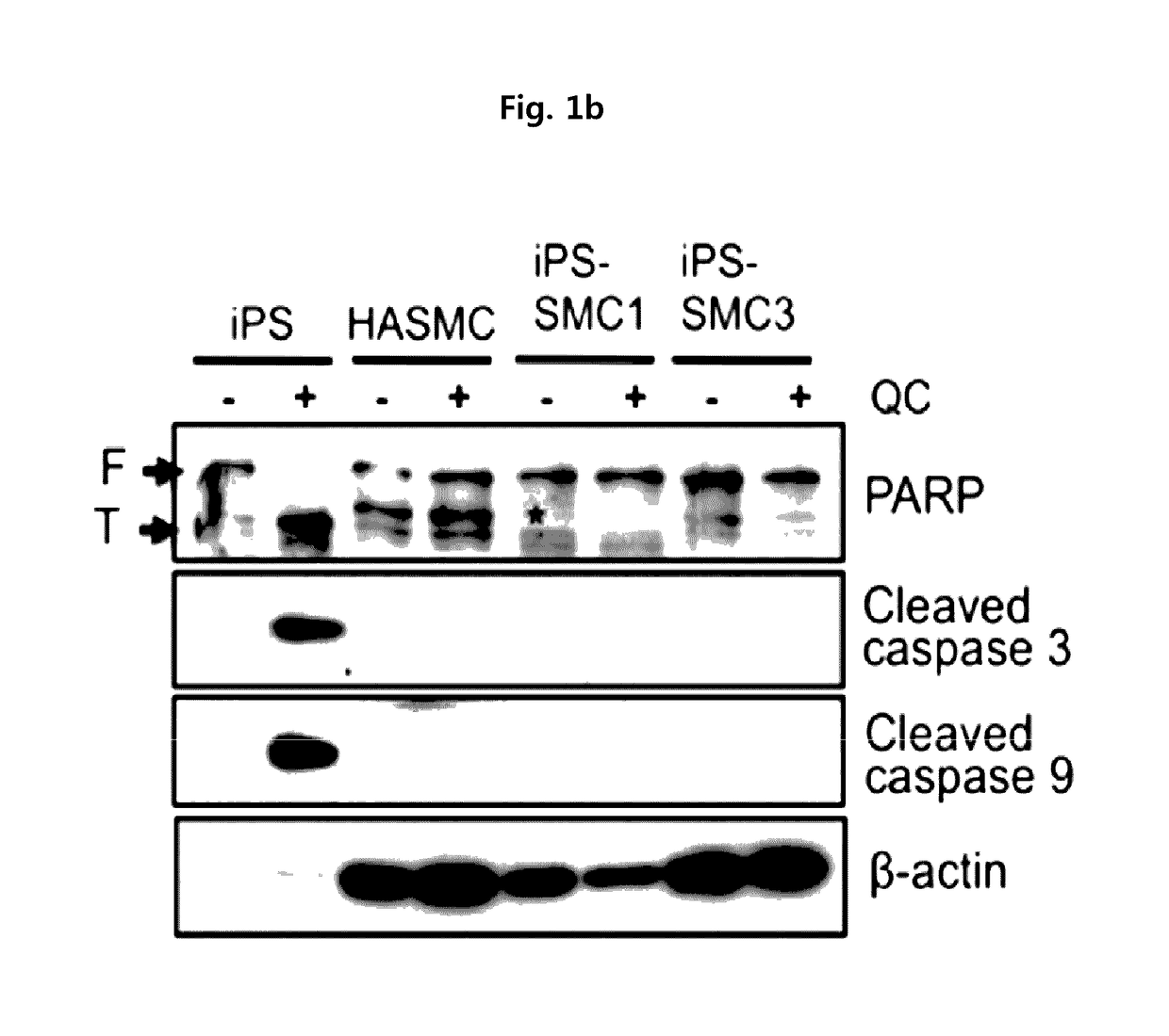 Method for suppressing teratoma formation via selective cell death induction in undifferentiated human-induced pluripotent stem cells