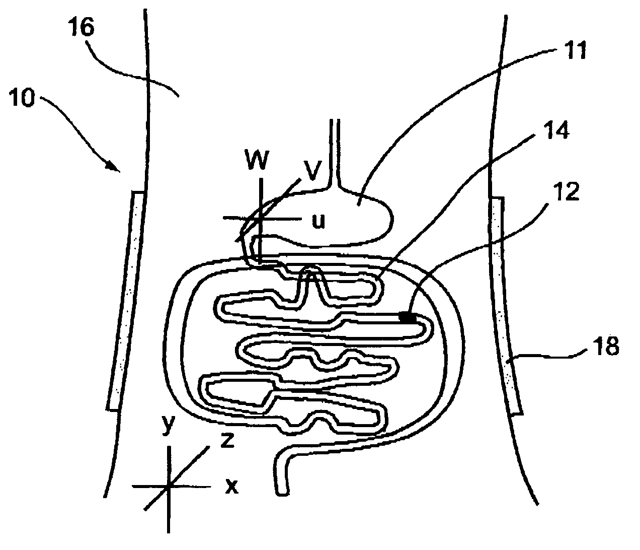 Ingestible pill for diagnosing a gastrointestinal tract