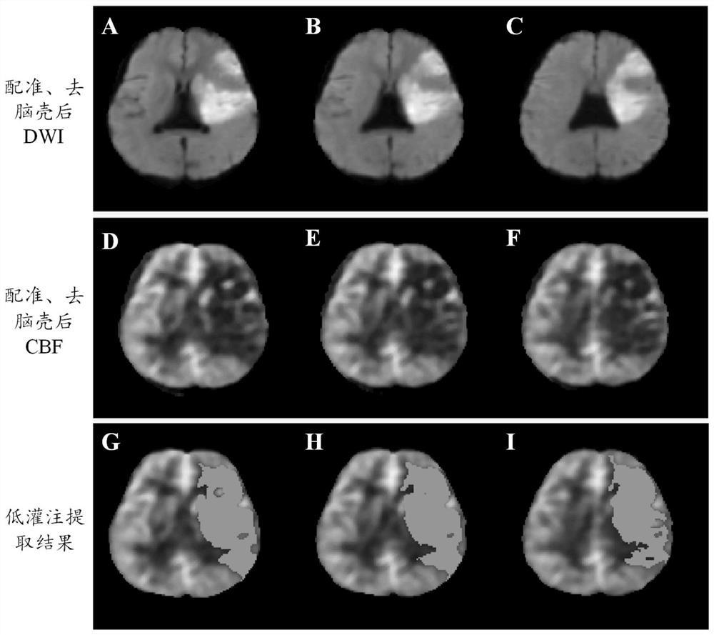 Arterial spin labeling-based cerebral hypoperfusion region accurate quantification method