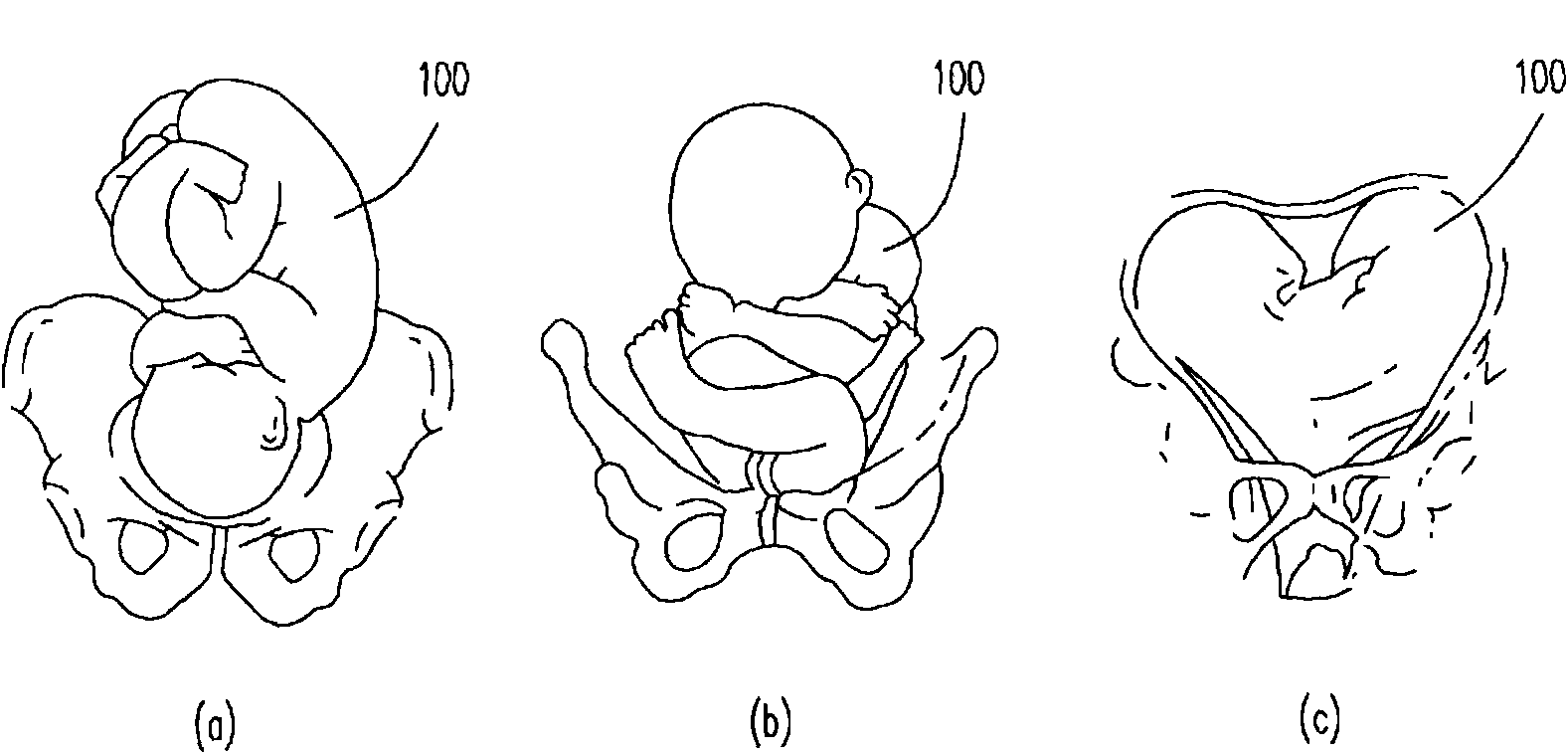 Maternal fetus monitoring device and method