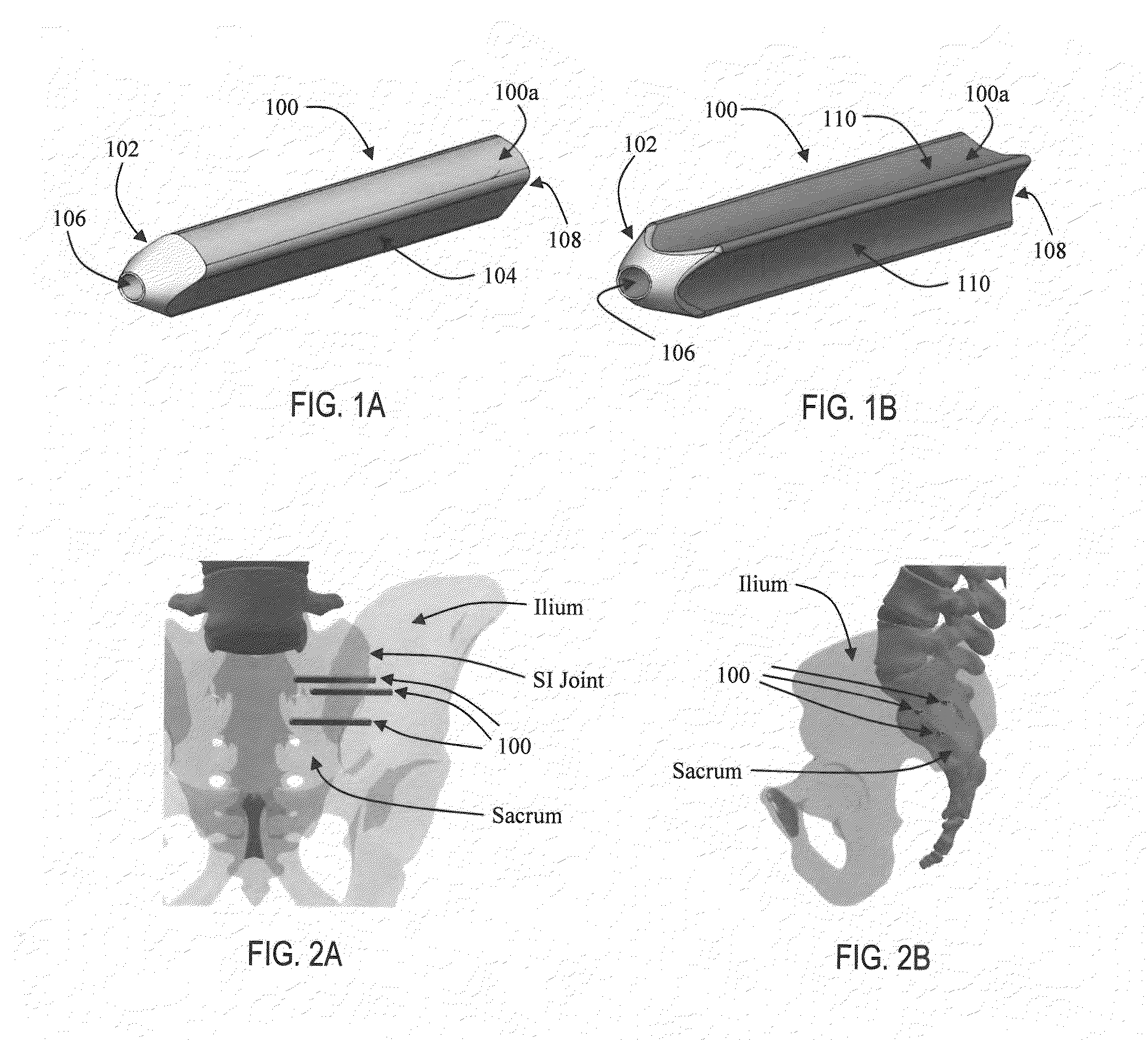 Apparatus and methods for immobilization and fusion of a synovial joint