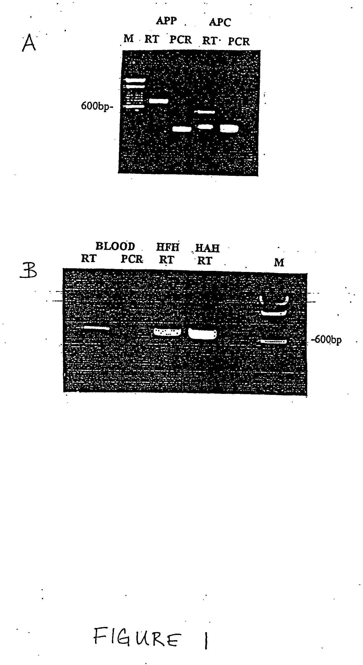 Method for the detection of rheumatoid arthritis related gene transcripts in blood