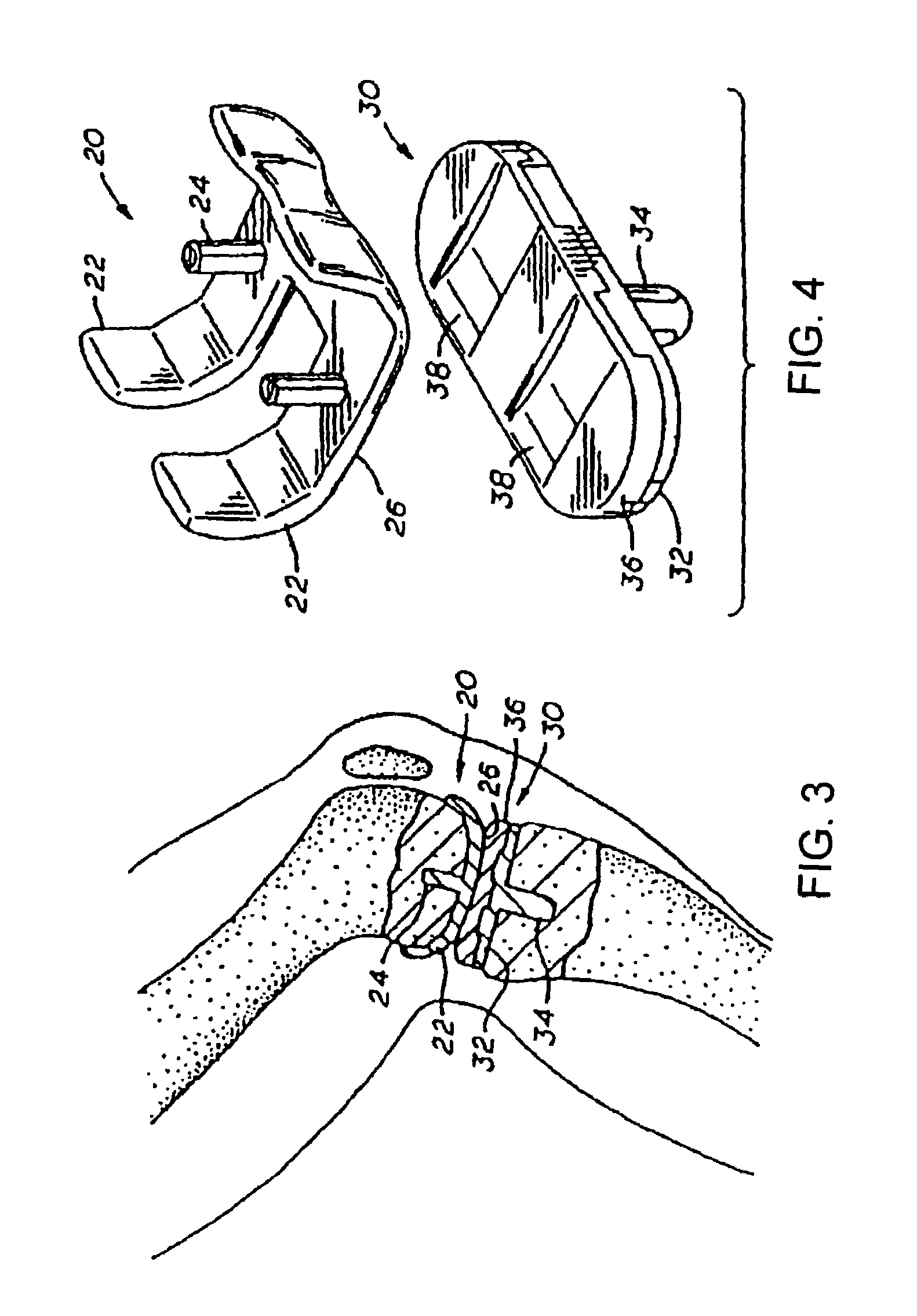 Method of surface oxidizing zirconium and zirconium alloys and resulting product