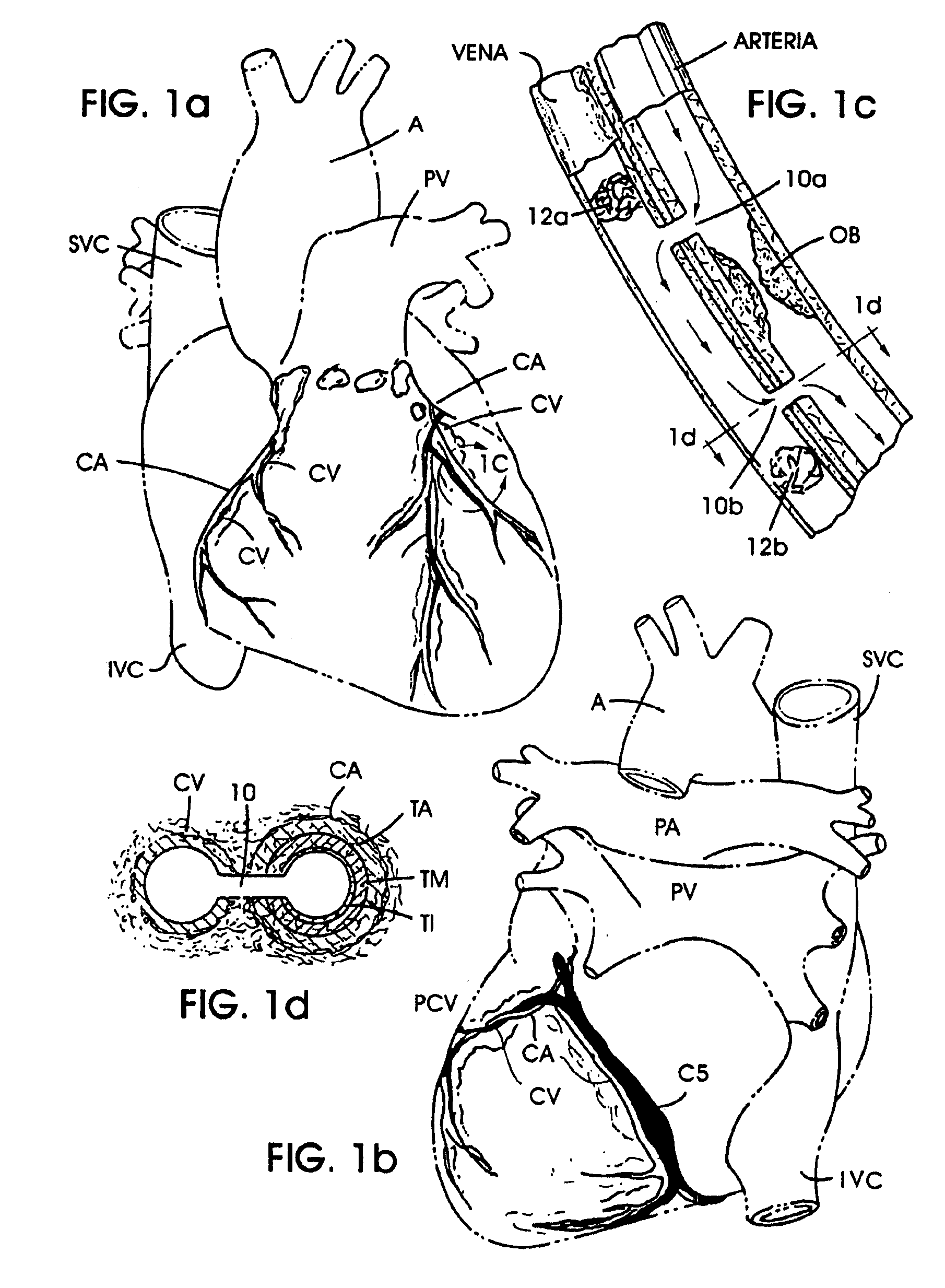 Methods and apparatus for bypassing arterial obstructions and/or performing other transvascular procedures