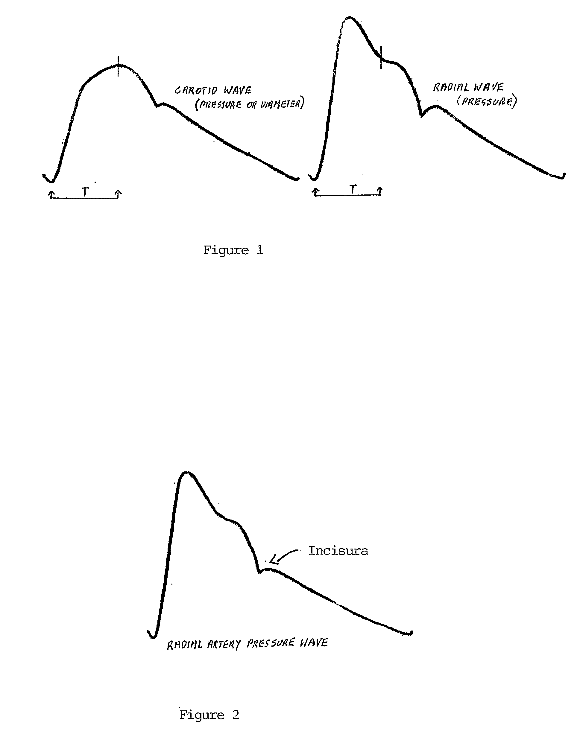 Method and apparatus for determination of central aortic pressure