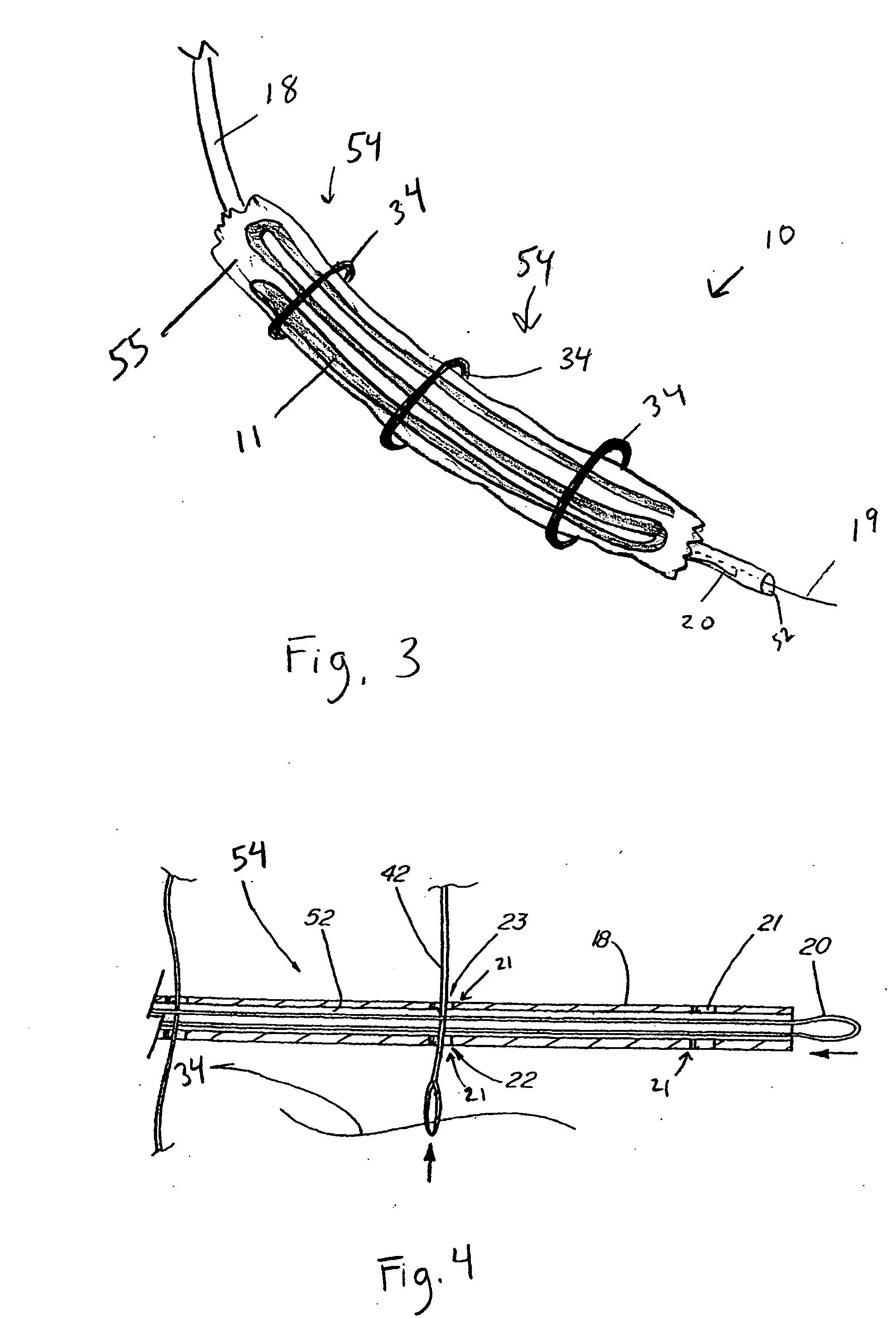 Coiled intragastric member for treating obesity