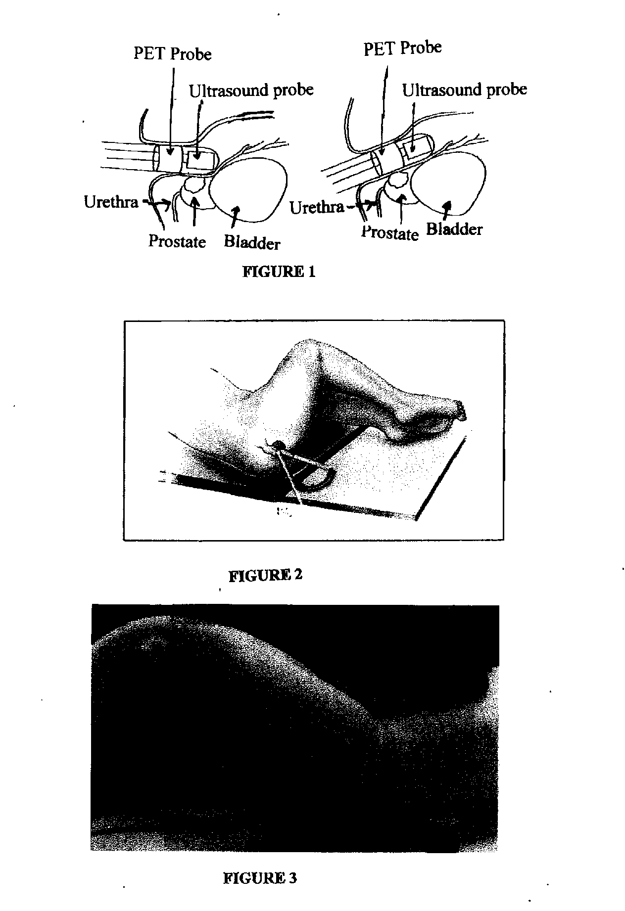 Endorectal Prostate Probe With Combined PET and US Modalities