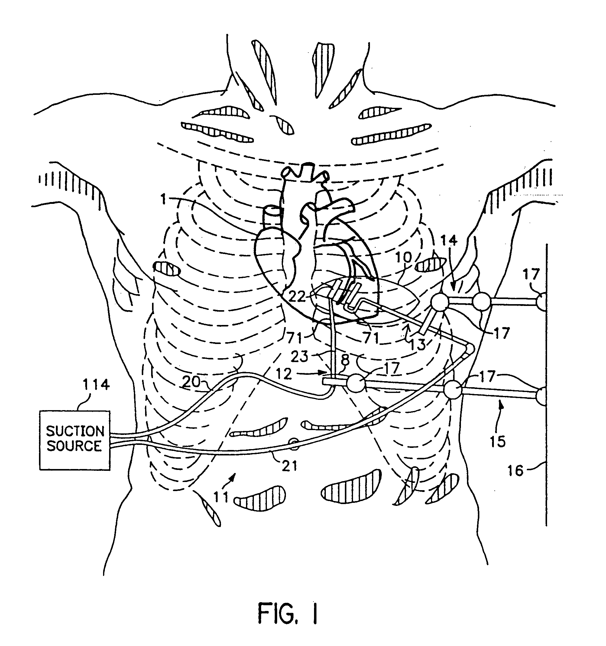 Method and apparatus for temporarily immobilizing a local area of tissue