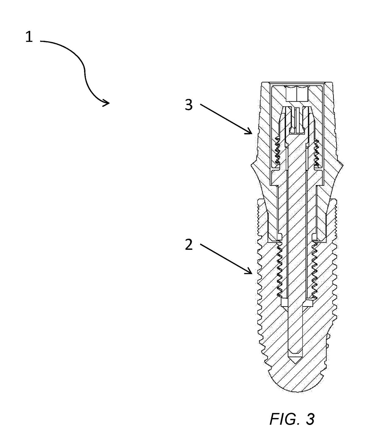 Dental implant system with positive abutment screw locking and retrieval mechanism