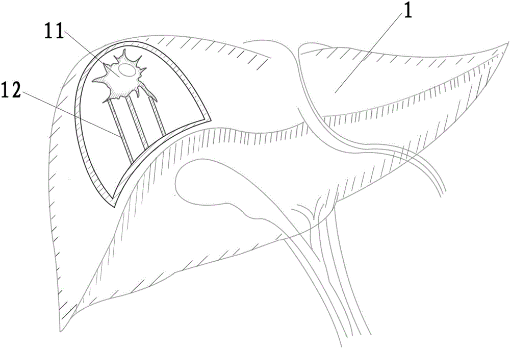 Tumor-reductive surgery exercise model and manufacturing method thereof