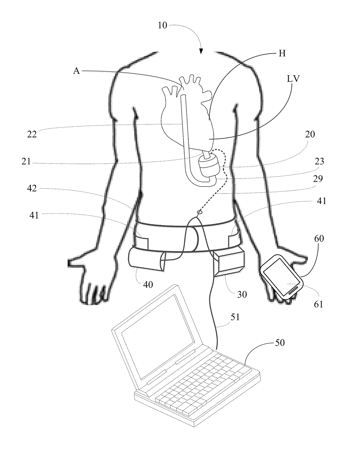 Implantable pump system having an undulating membrane