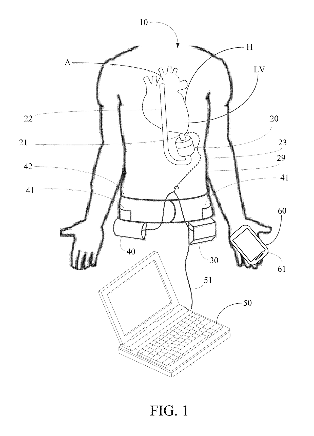 Implantable pump system having an undulating membrane