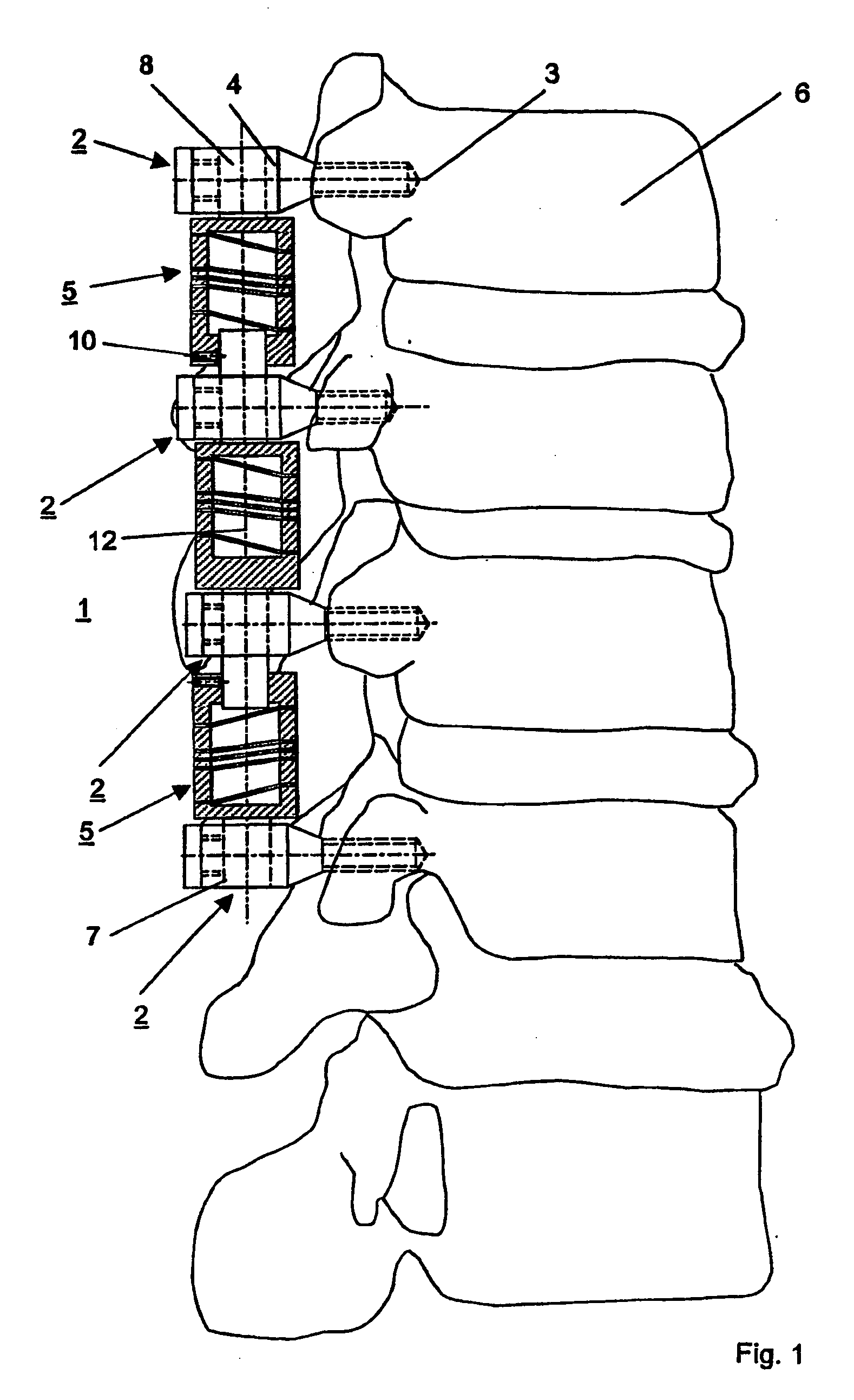 Device for elastically stabilizing vertebral bodies