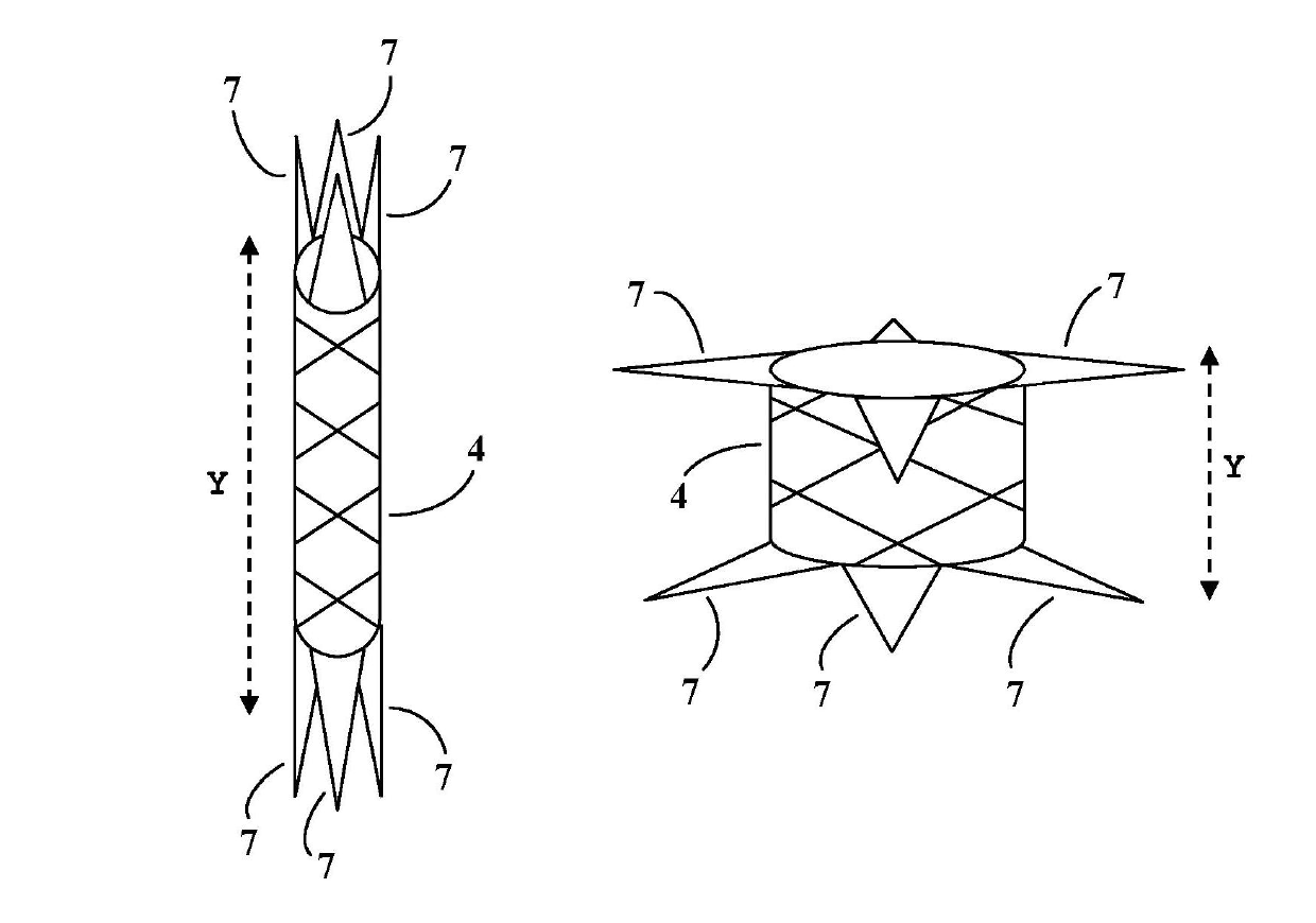 Valve prosthesis