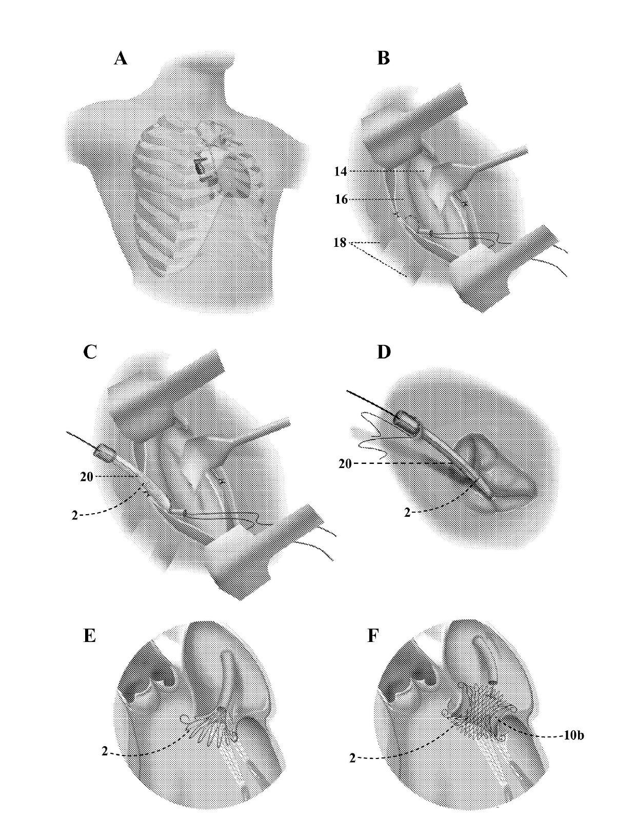 Valve prosthesis