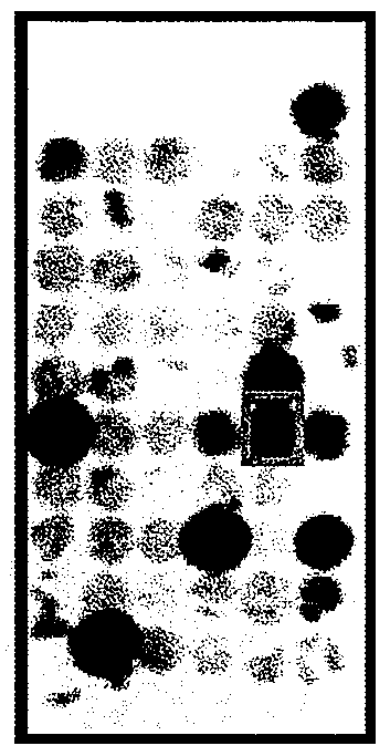 Method of Diagnosing and Treating Glioma