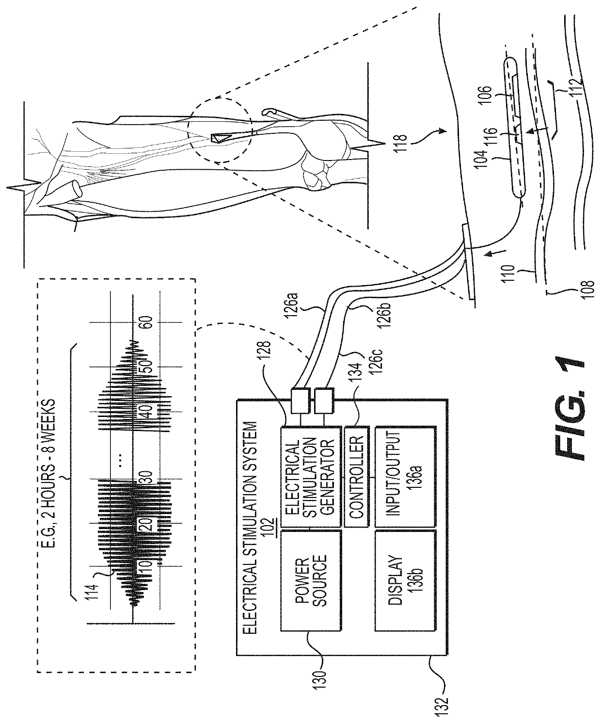 System and method to percutaneously block painful sensations