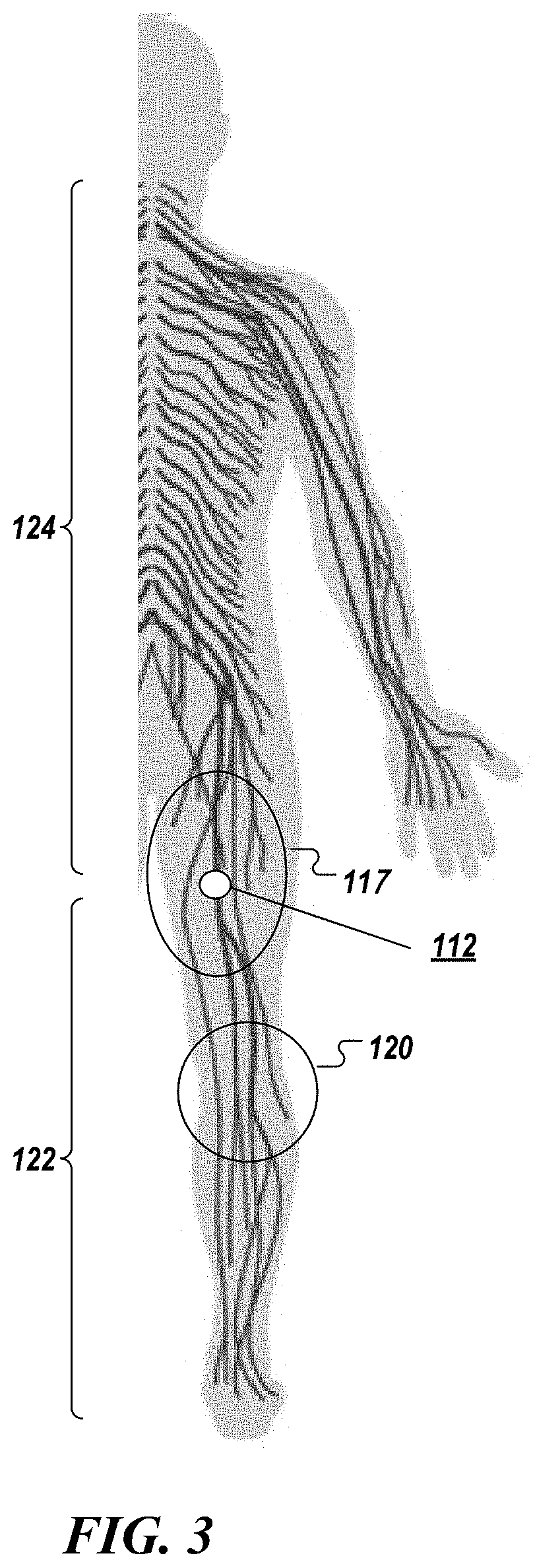 System and method to percutaneously block painful sensations