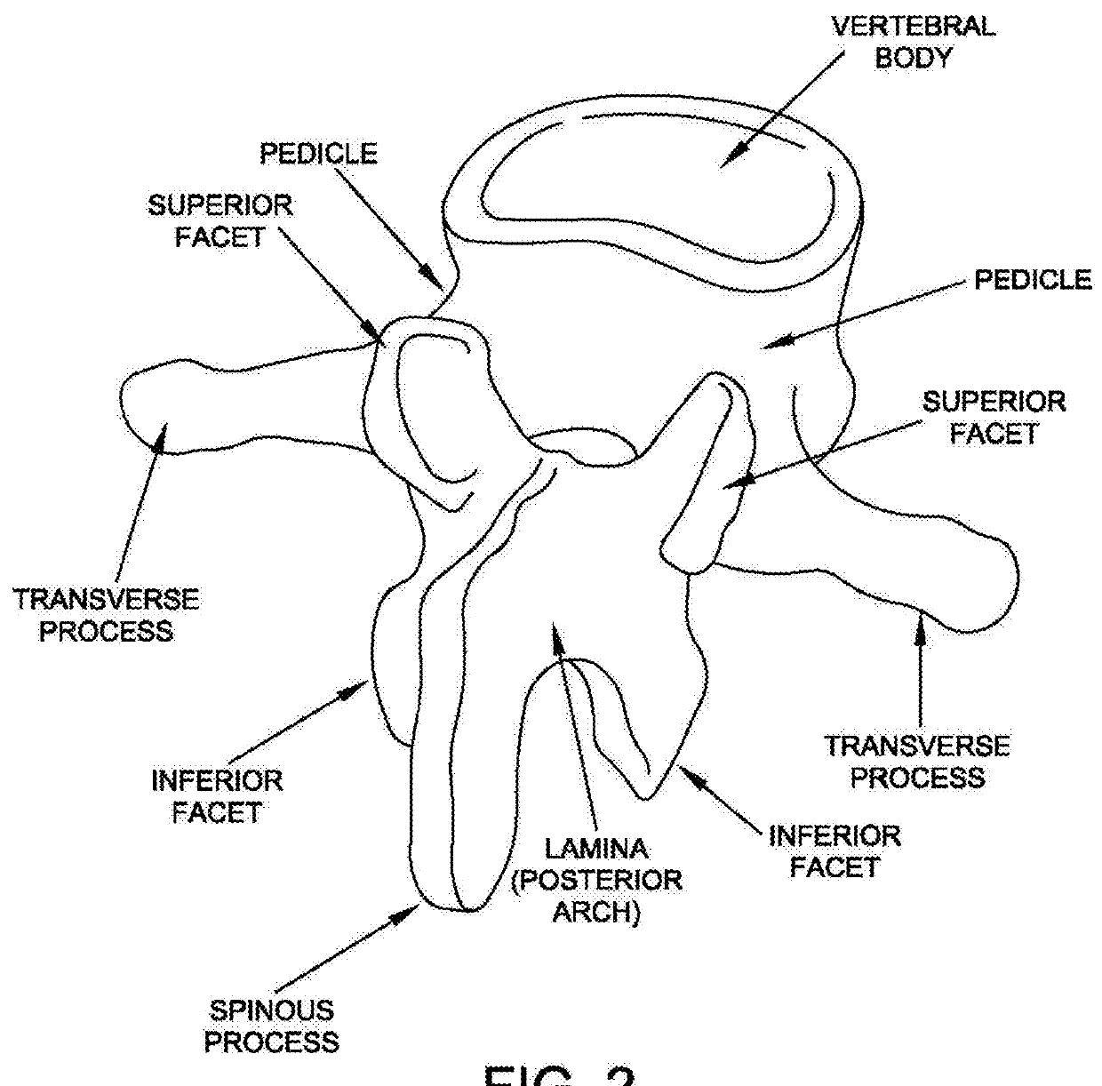 Sublaminar spinal fixation system and method of use