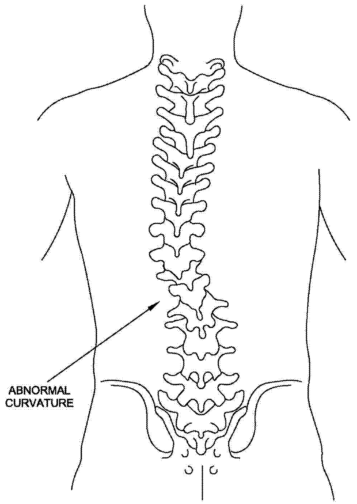 Sublaminar spinal fixation system and method of use