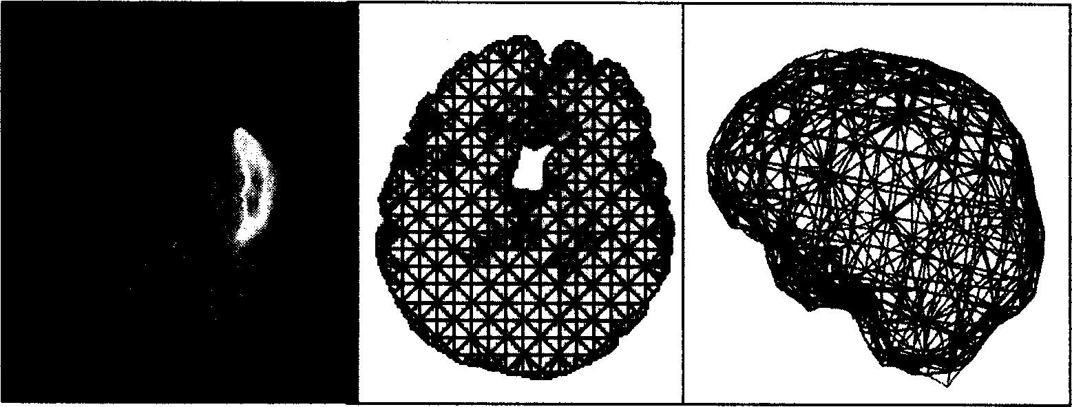 Method for correcting brain tissue deformation in navigation system of neurosurgery