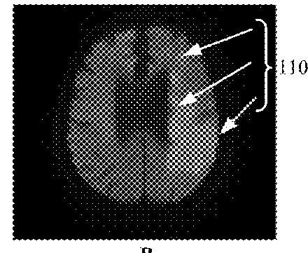 Method for detecting and quantifying cerebral infarct