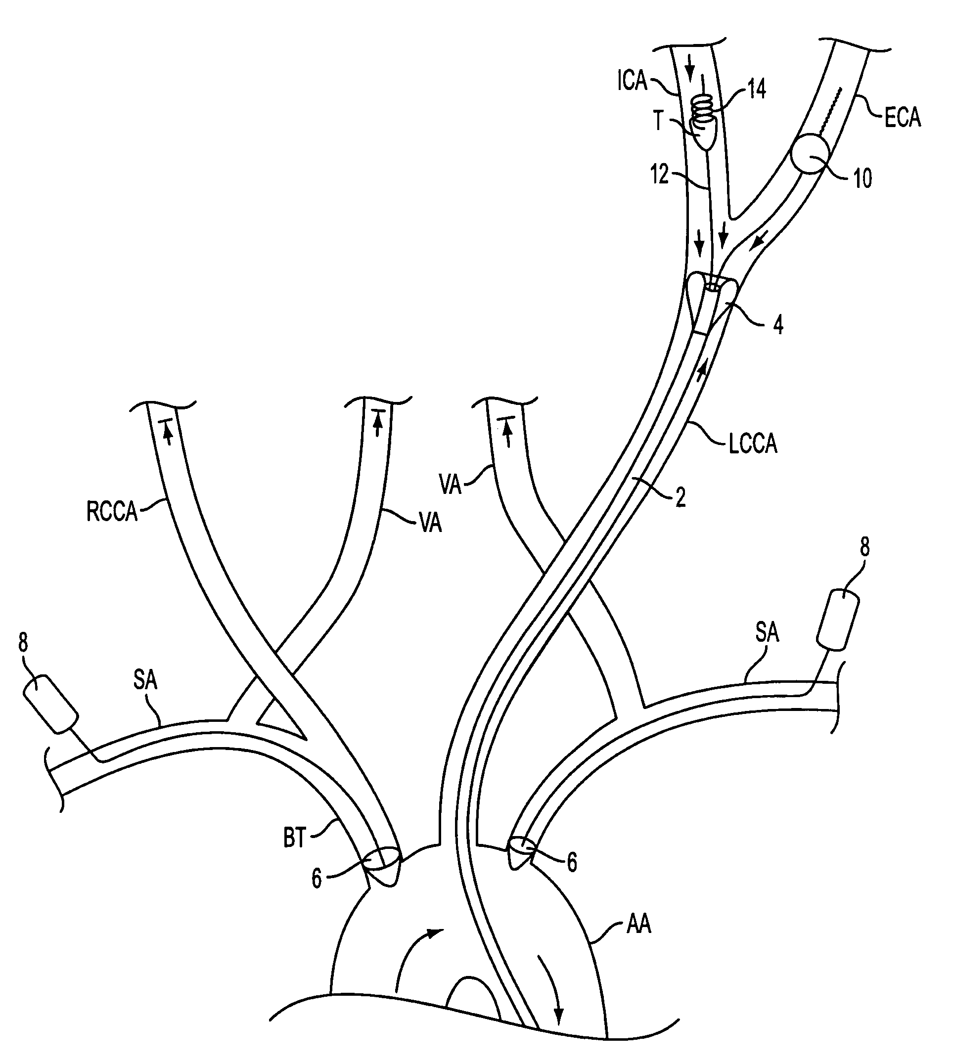 Apparatus and methods for treating stroke and controlling cerebral flow characteristics