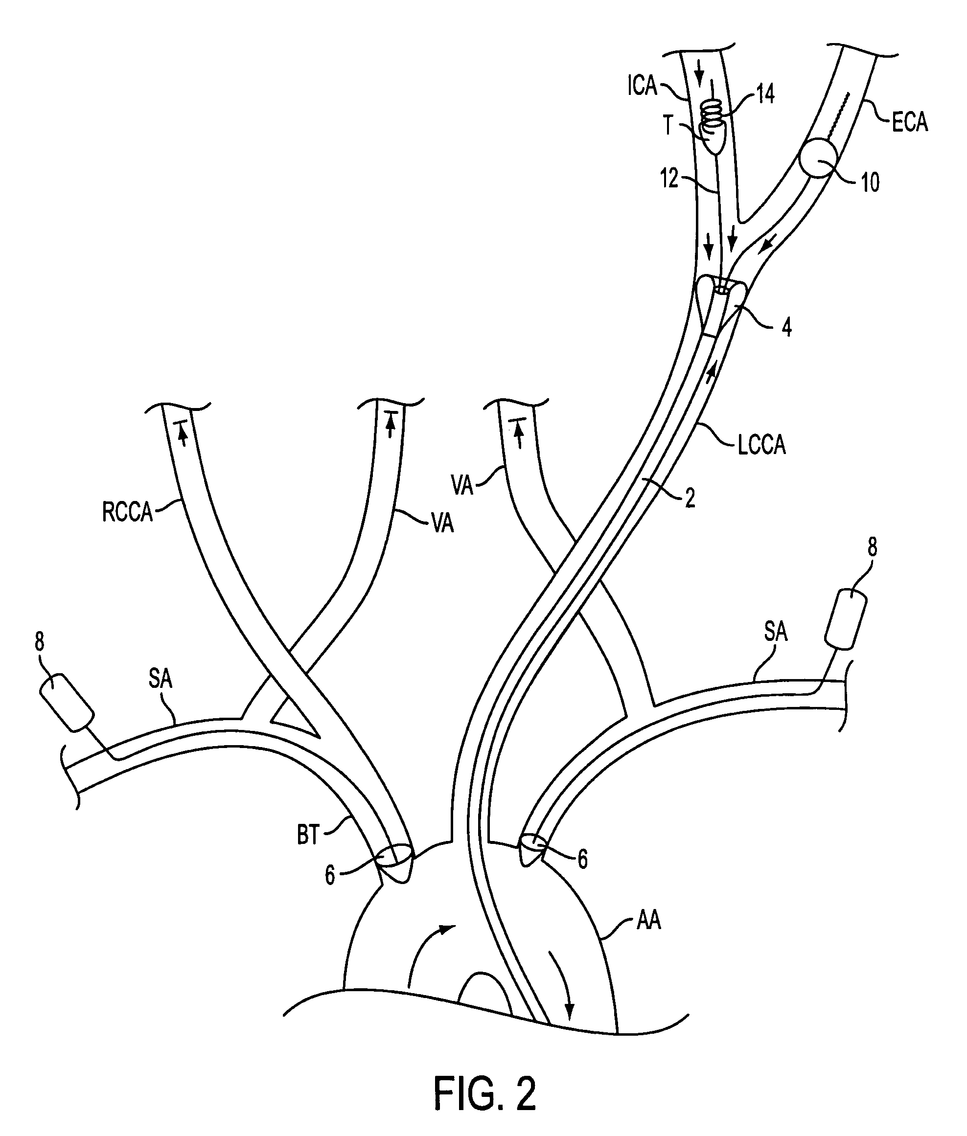 Apparatus and methods for treating stroke and controlling cerebral flow characteristics